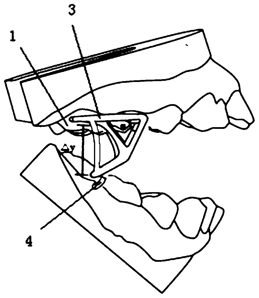 Personalized customized fixed-function appliance for mandibular protrusion