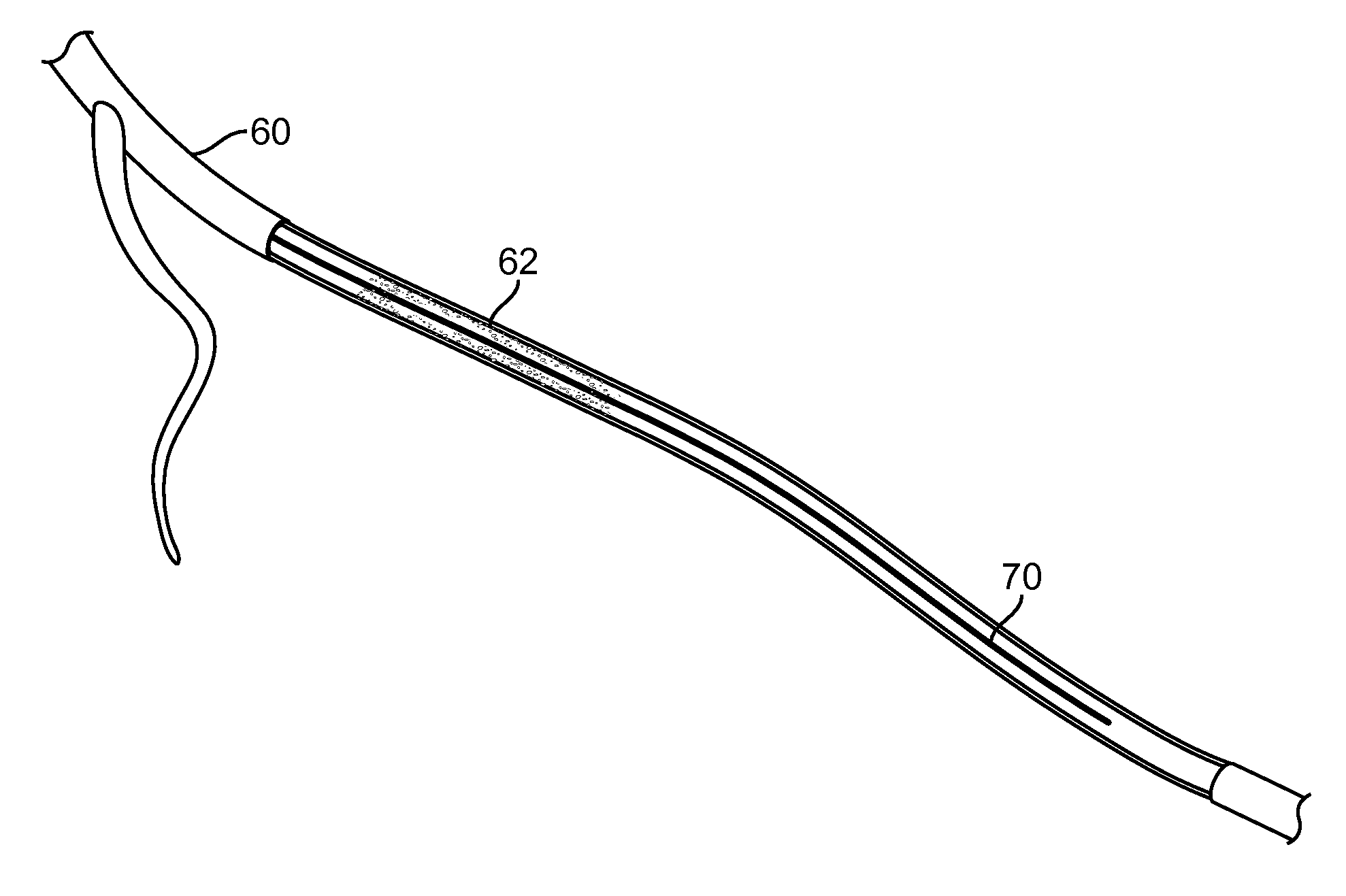 Indirect-release electrolytic implant delivery systems