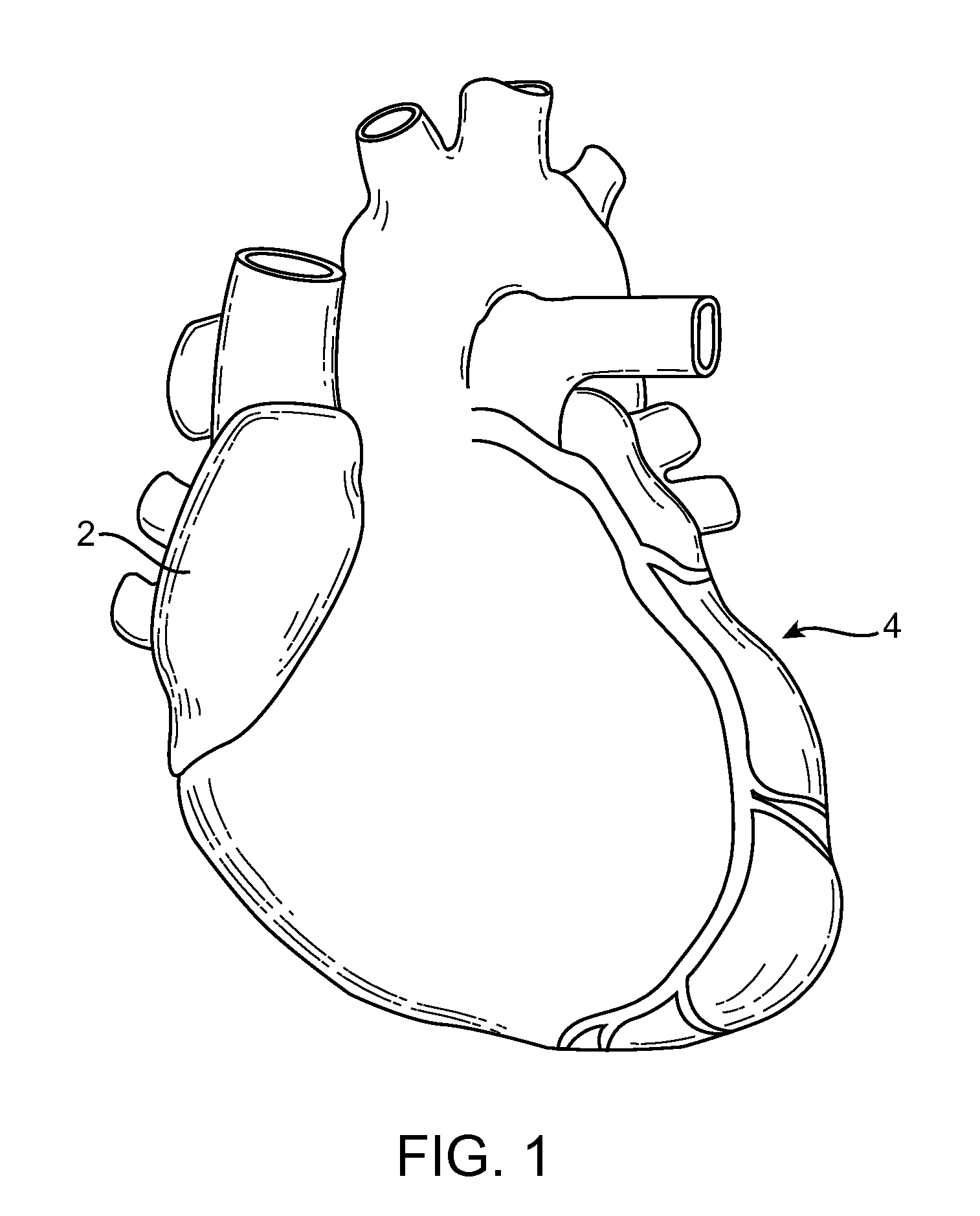 Indirect-release electrolytic implant delivery systems