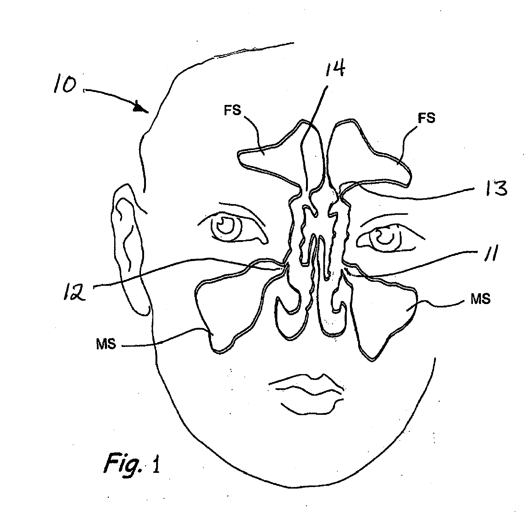 Devices and Methods for Dilating a Paranasal Sinus Opening and for Treating Sinusitis