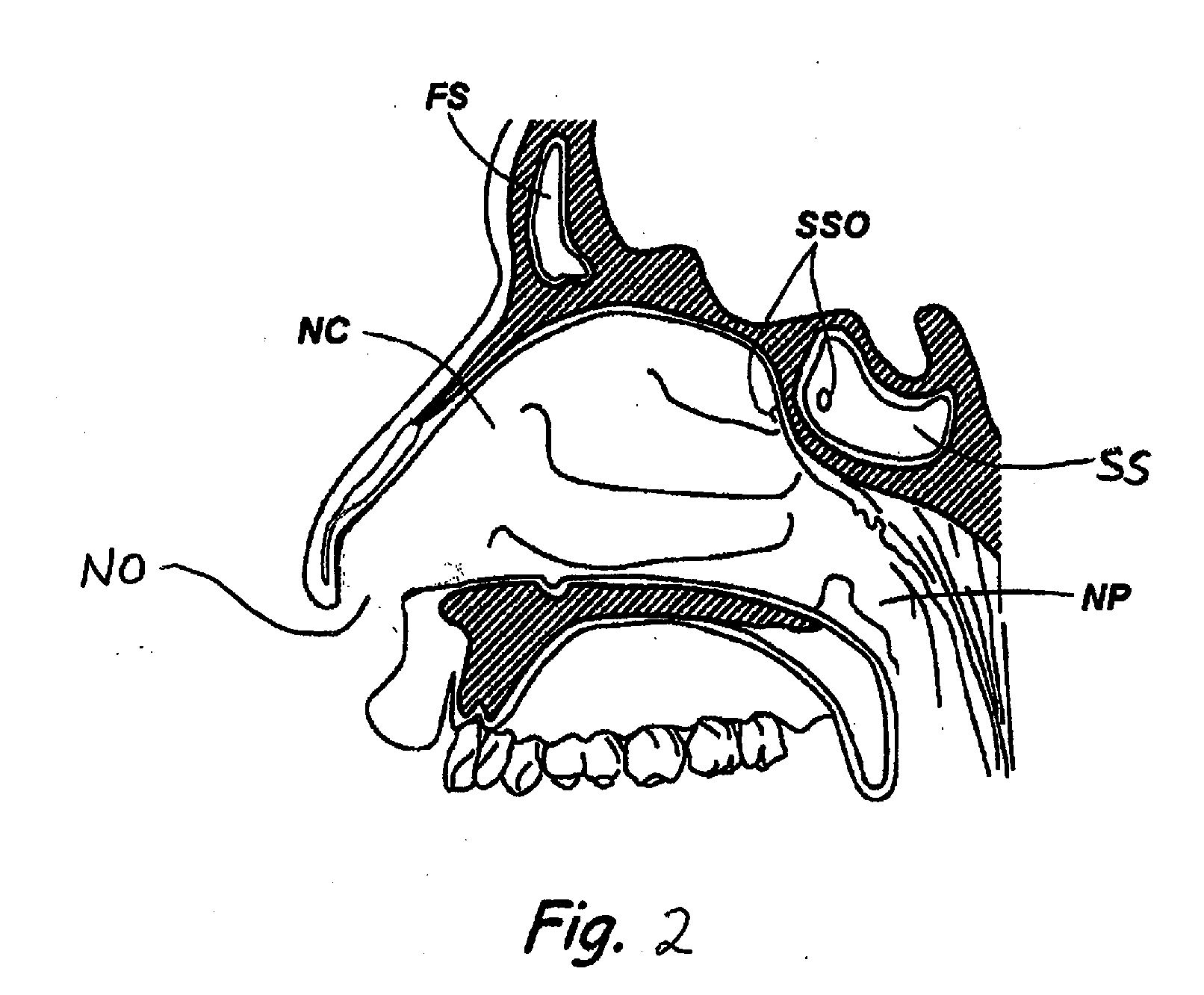 Devices and Methods for Dilating a Paranasal Sinus Opening and for Treating Sinusitis