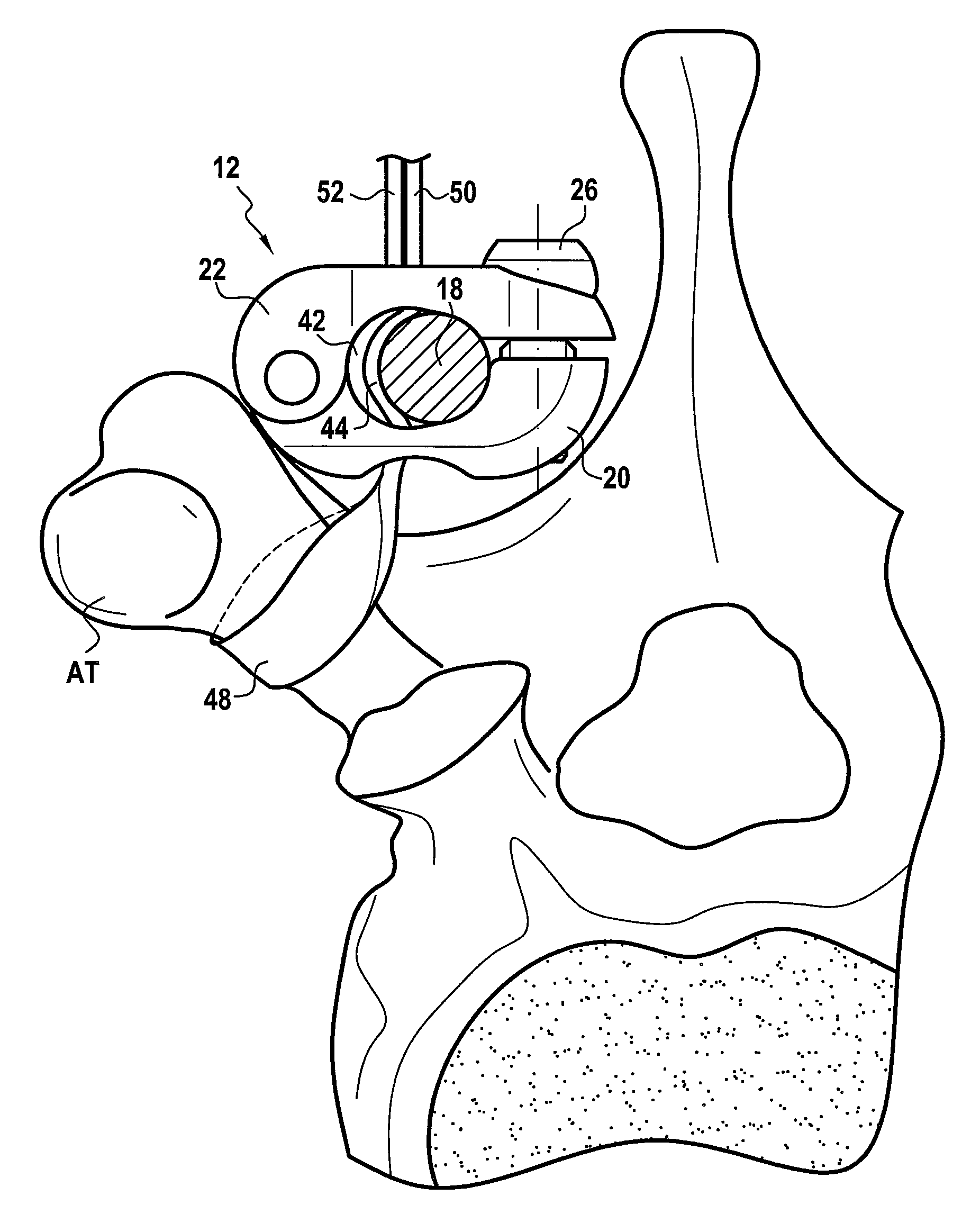 Vertebral fixing system