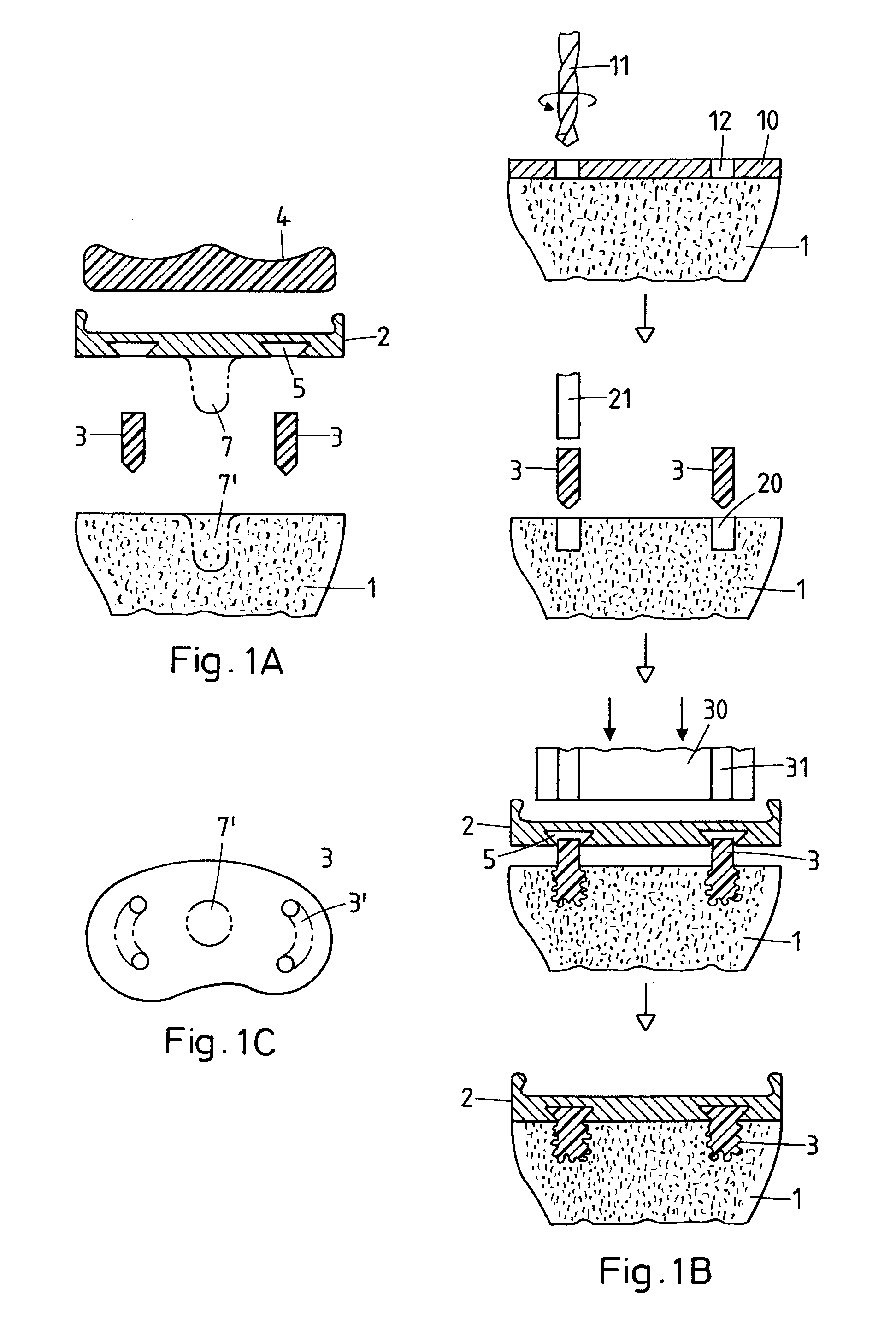 Method for fastening an implant to bone tissue and corresponding implant system