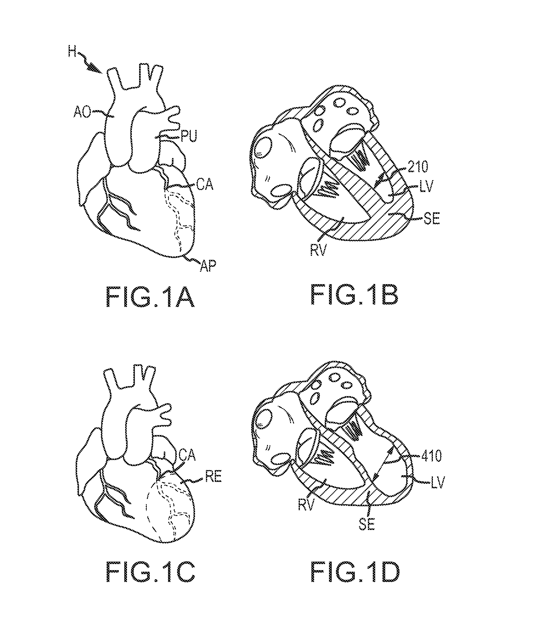 Remote pericardial hemostasis for ventricular access and reconstruction or other organ therapies