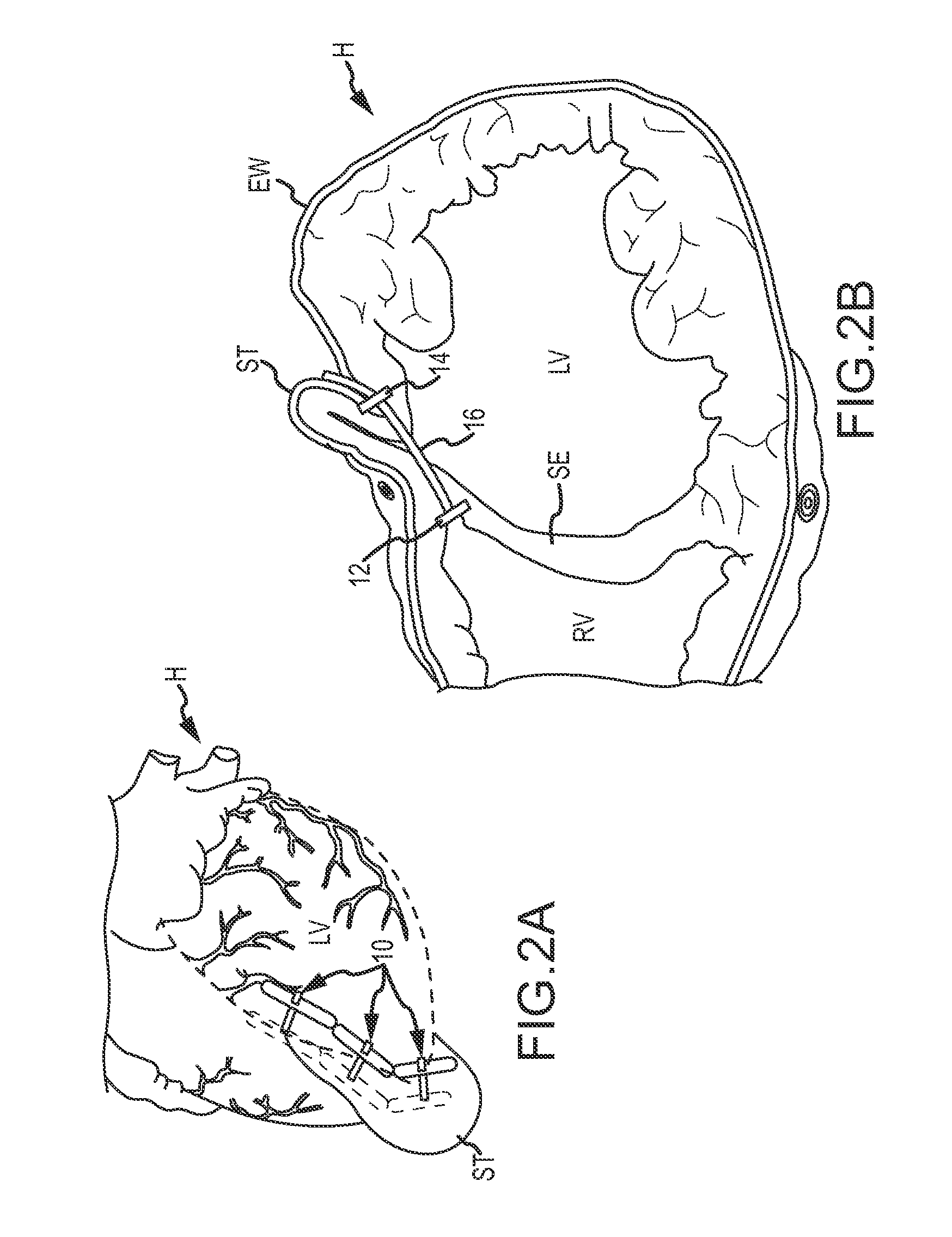 Remote pericardial hemostasis for ventricular access and reconstruction or other organ therapies