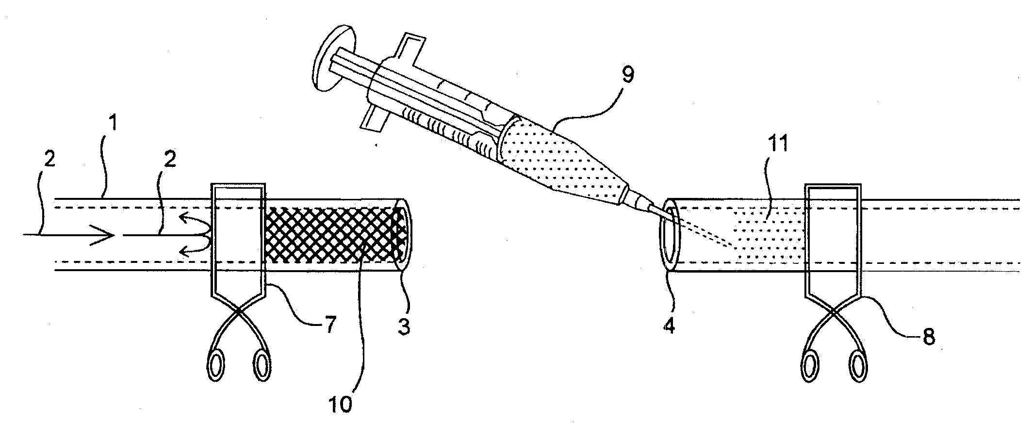 Compositions and methods for joining non-conjoined lumens