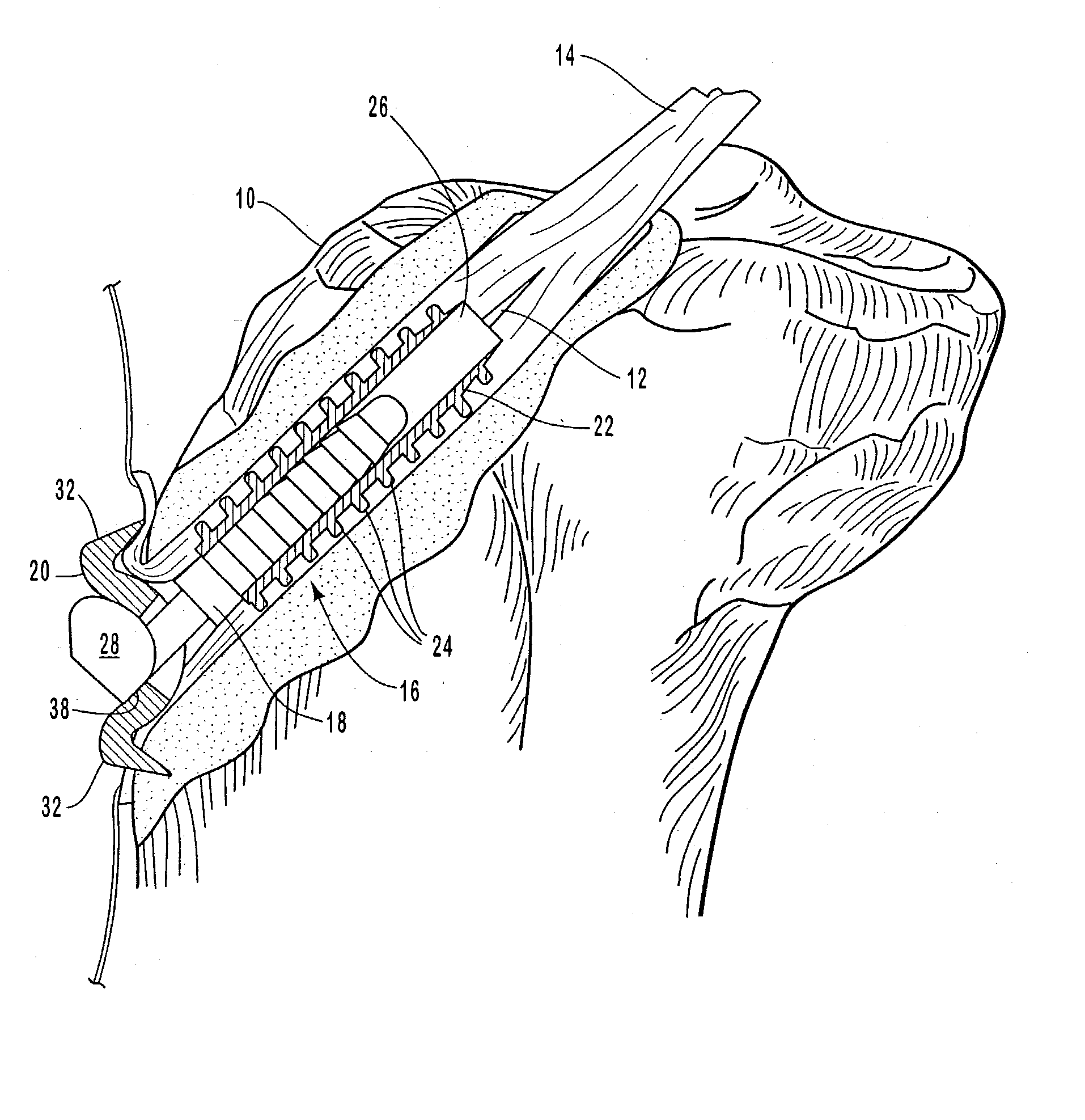 Securing connective tissue to a bone surface