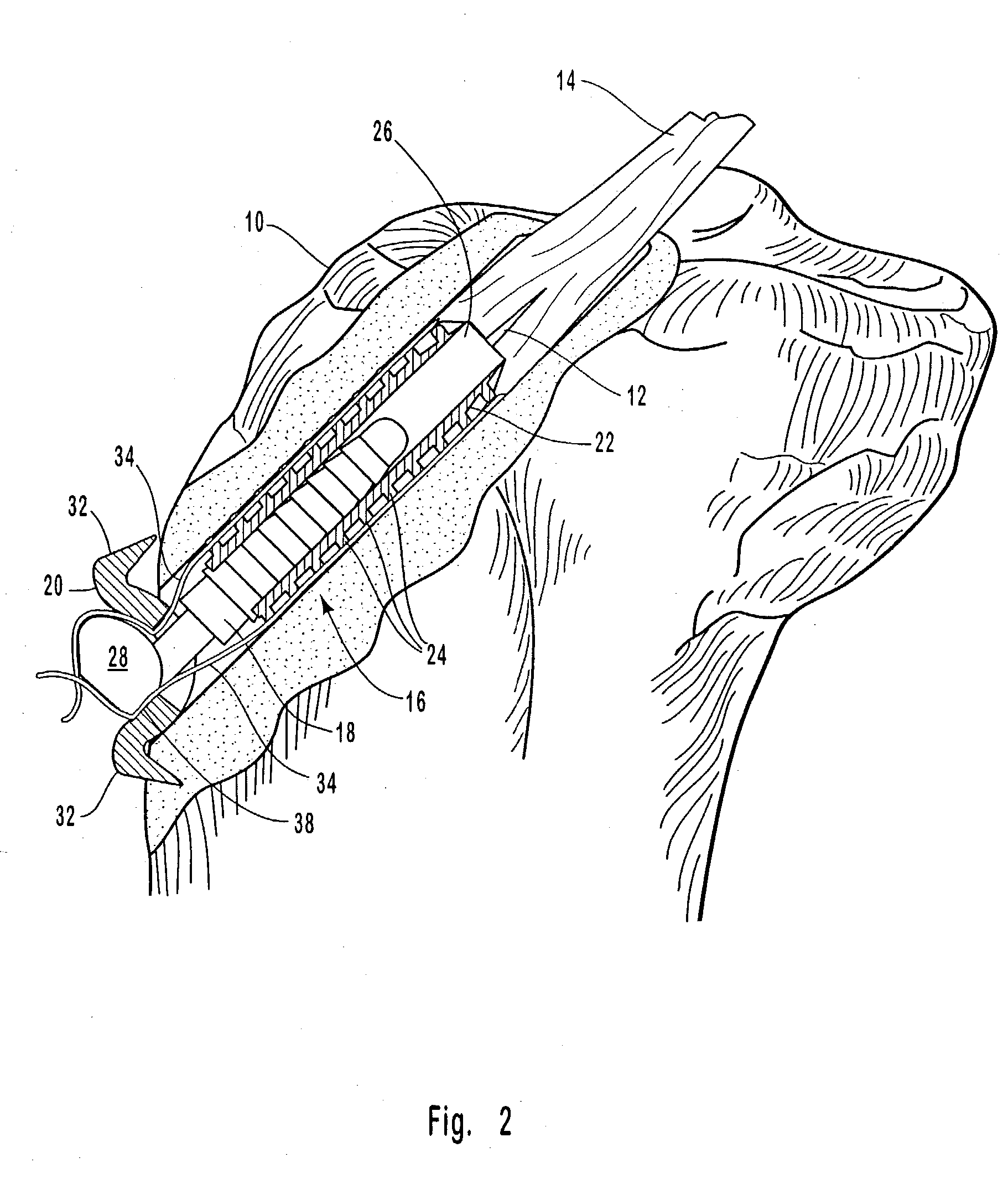 Securing connective tissue to a bone surface