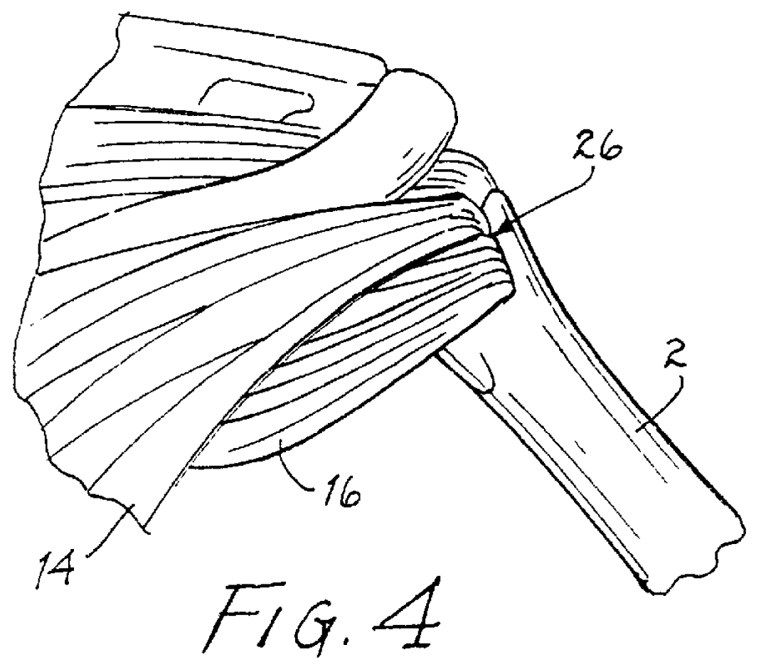 Method for surgical repair with hook-and-loop fastener