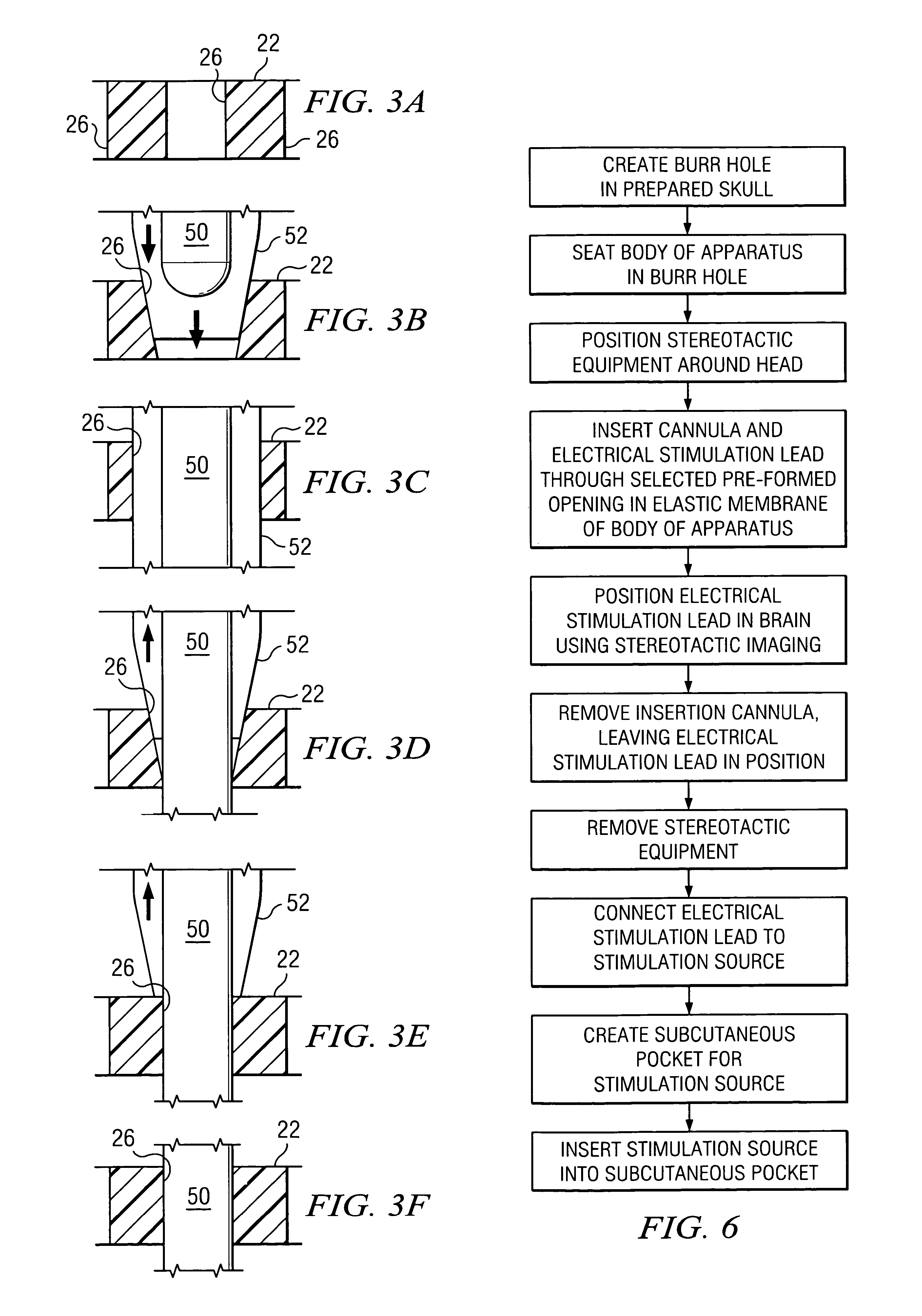 Electrical stimulation system and associated apparatus for securing an electrical stimulation lead in position in a person's brain