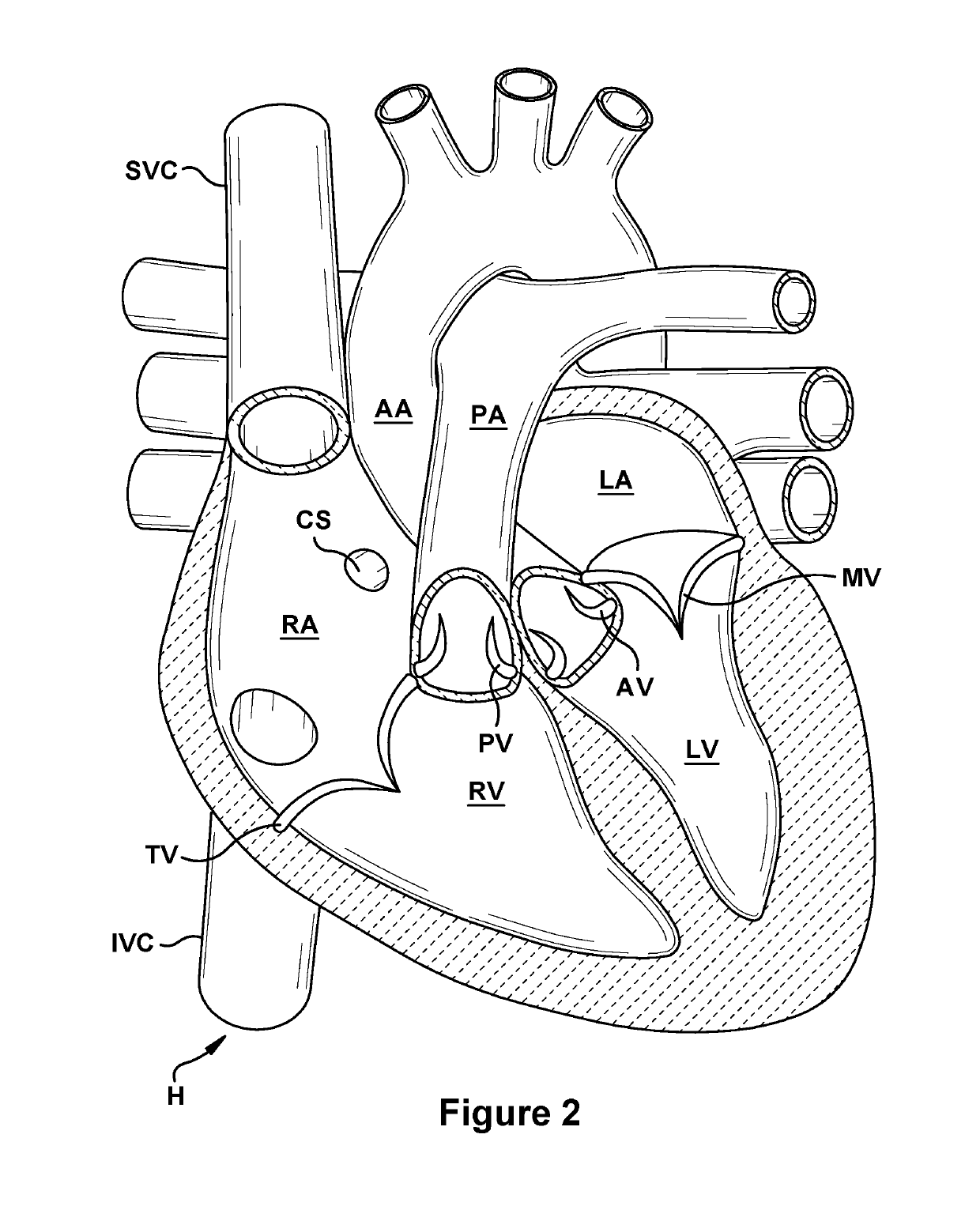 Native valve repair devices and procedures