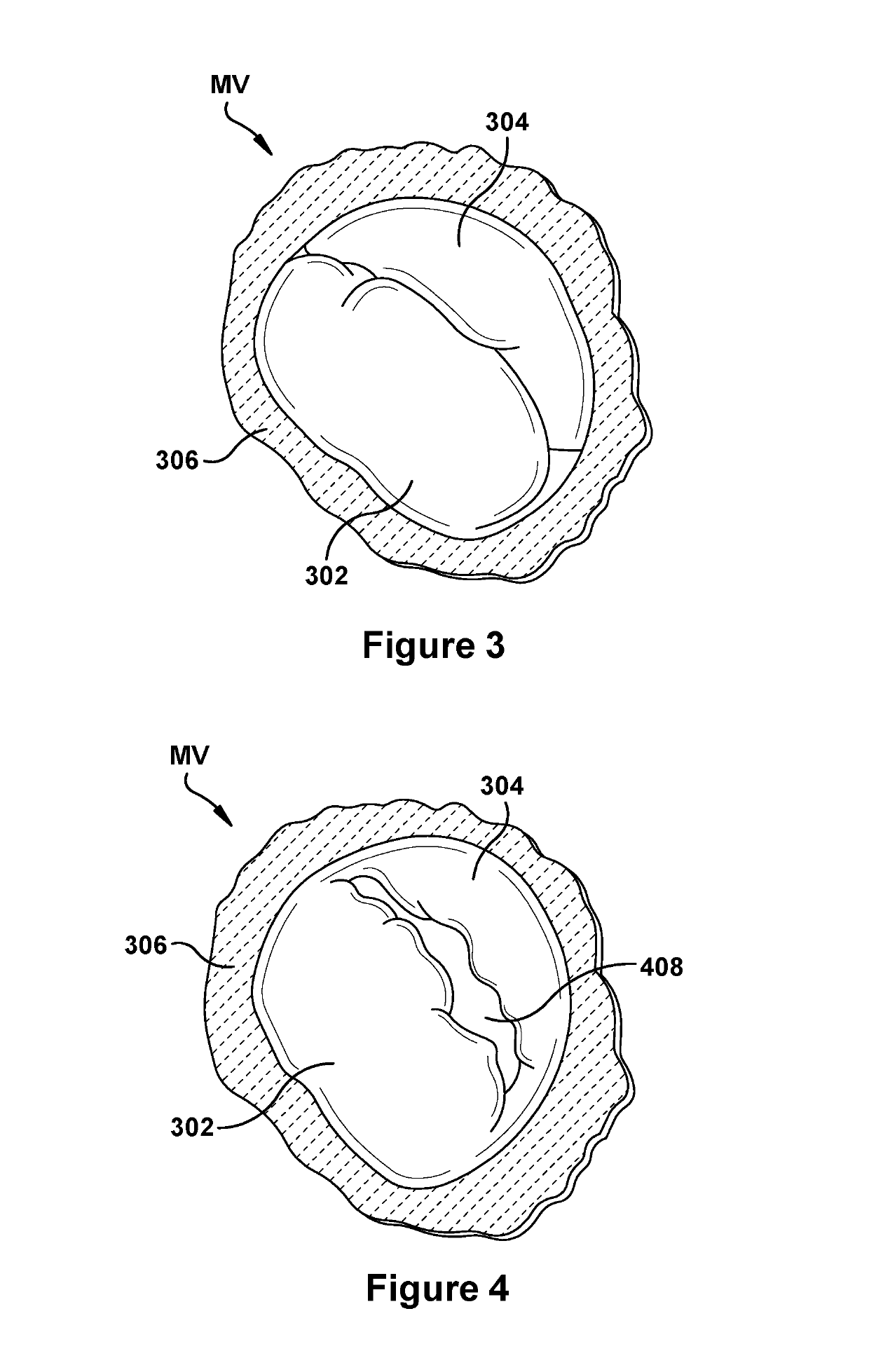 Native valve repair devices and procedures