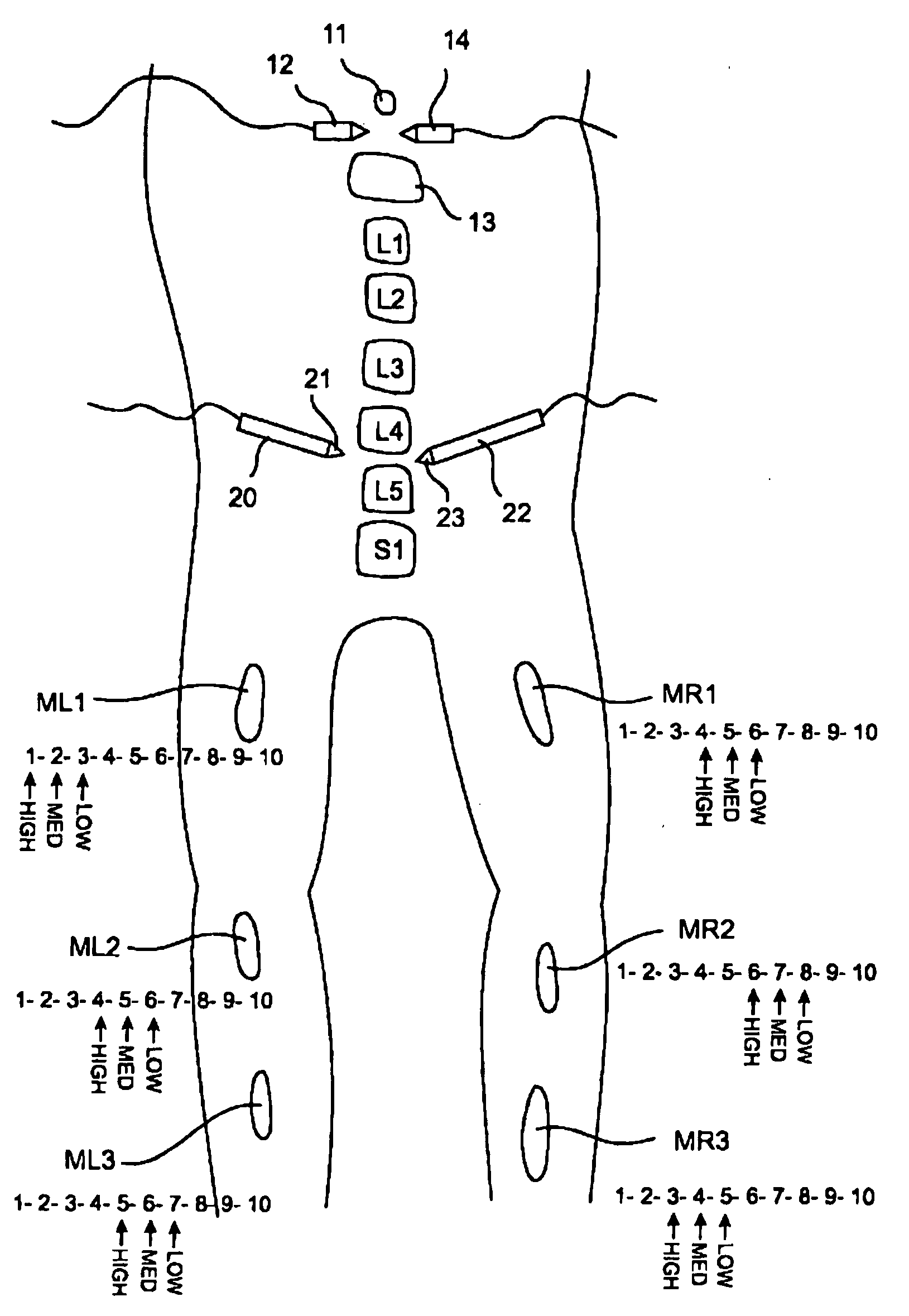 Electromyography system