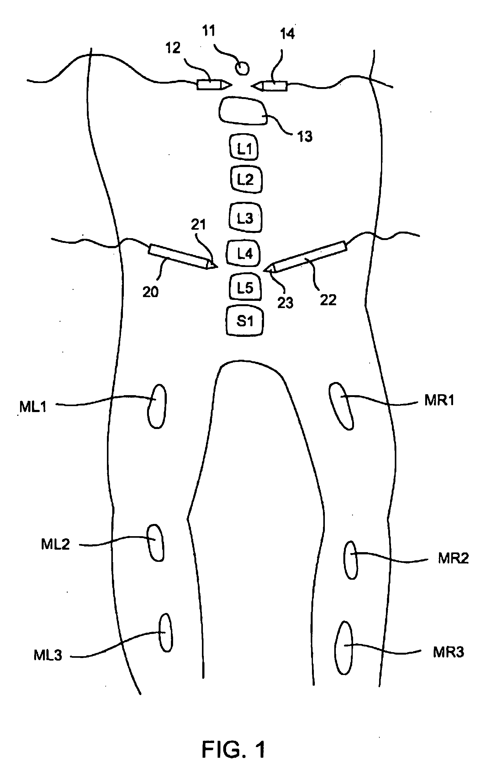 Electromyography system