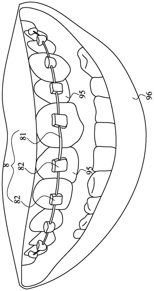 Orthodontic kit and manufacturing method thereof