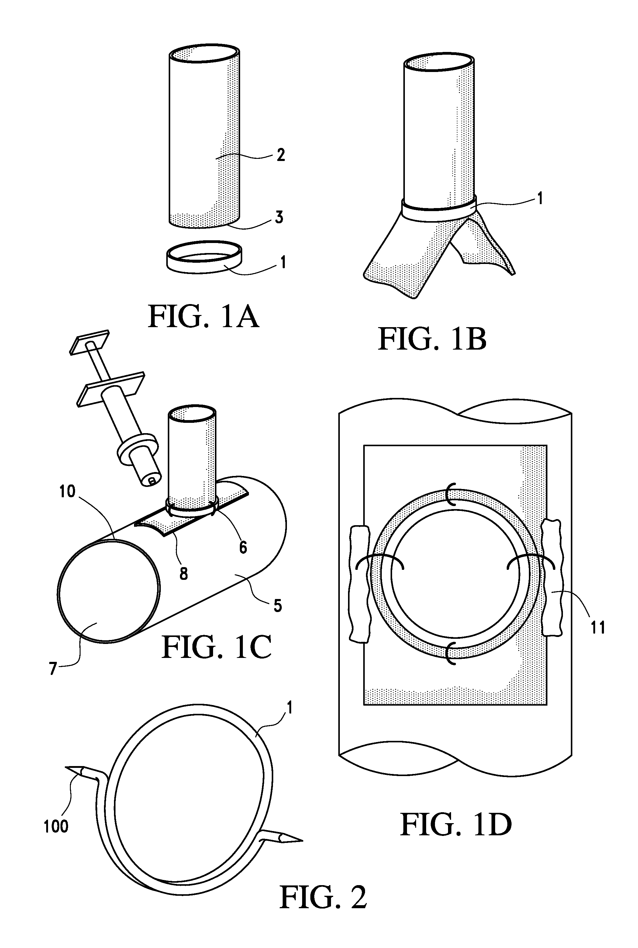 Device and method for joining vessels in anastomosis