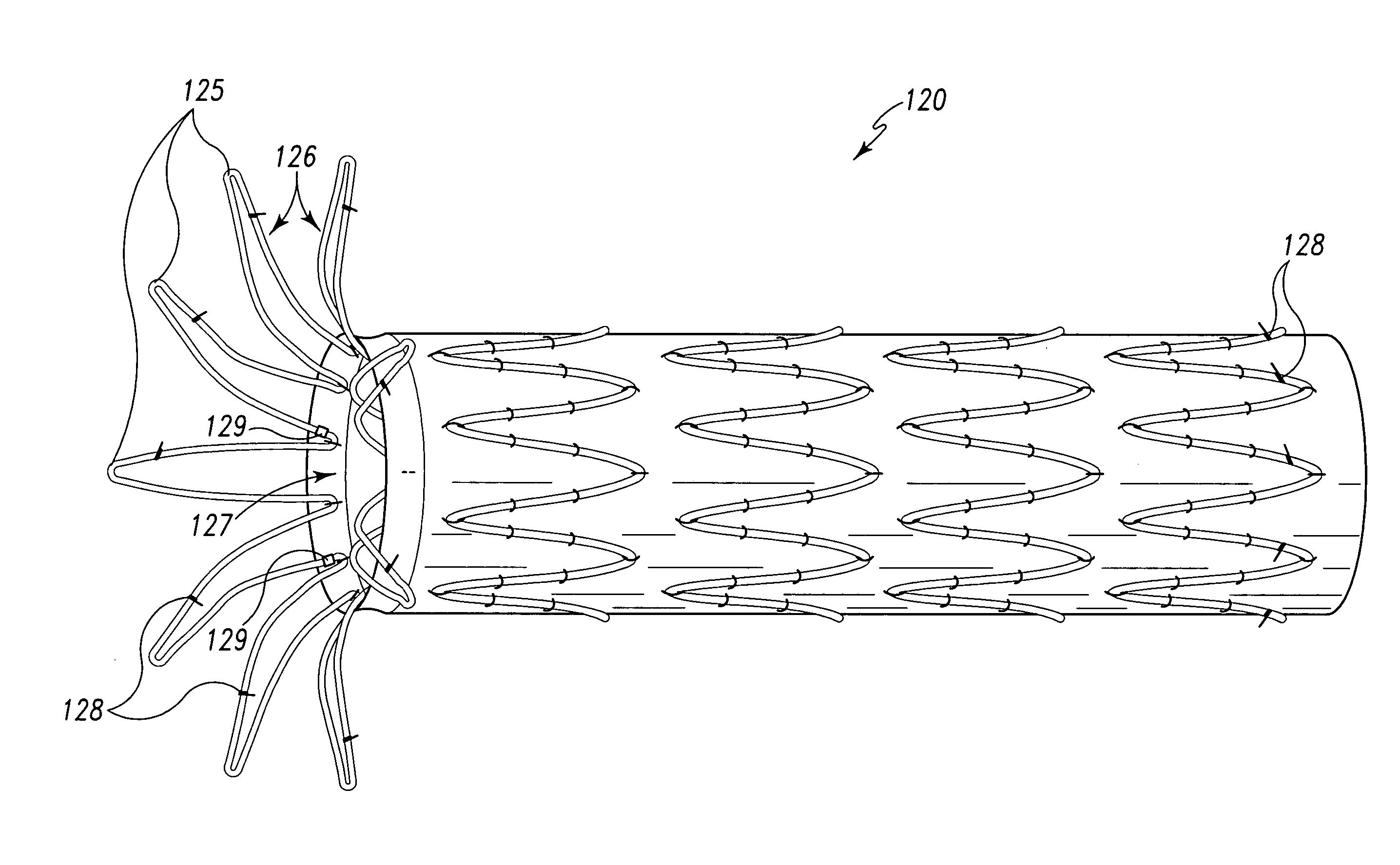 Fenestrated intraluminal stent system