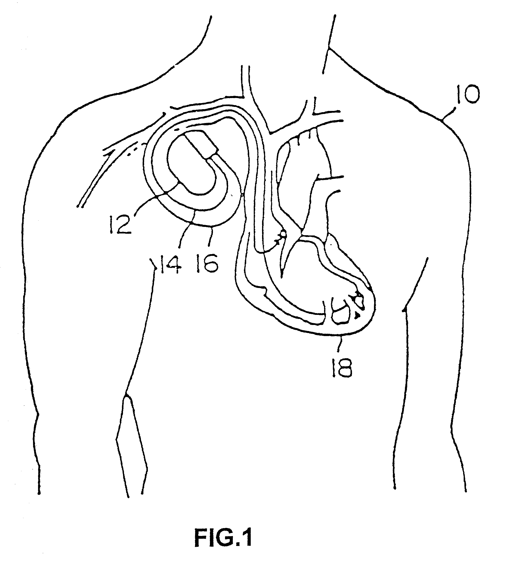 Co-extruded, multi-lumen medical lead