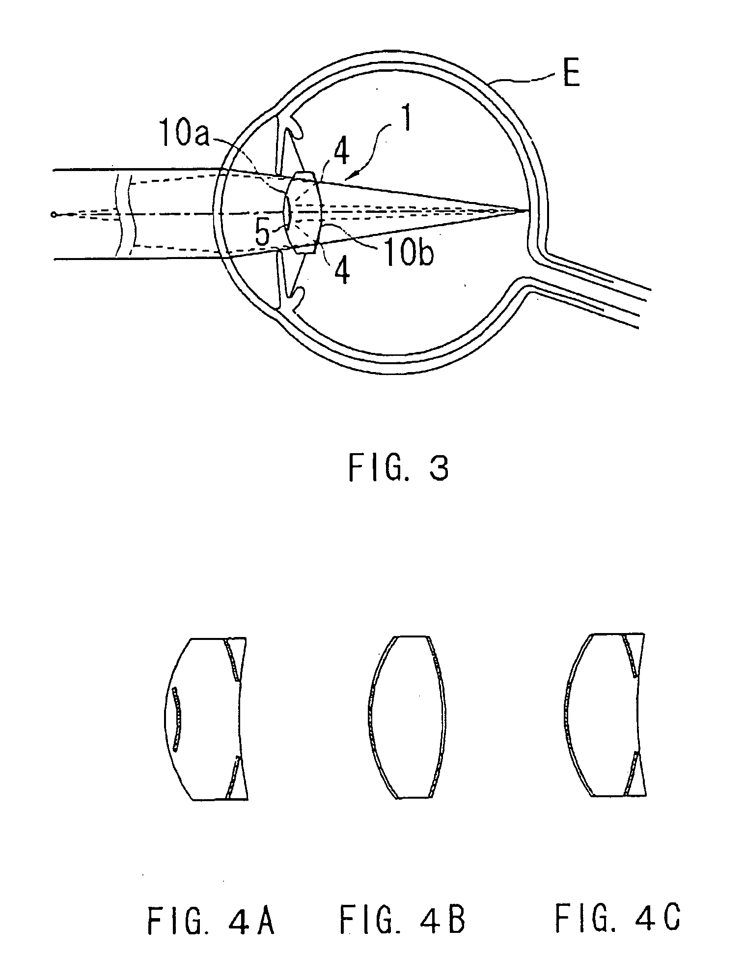 Intraocular lens