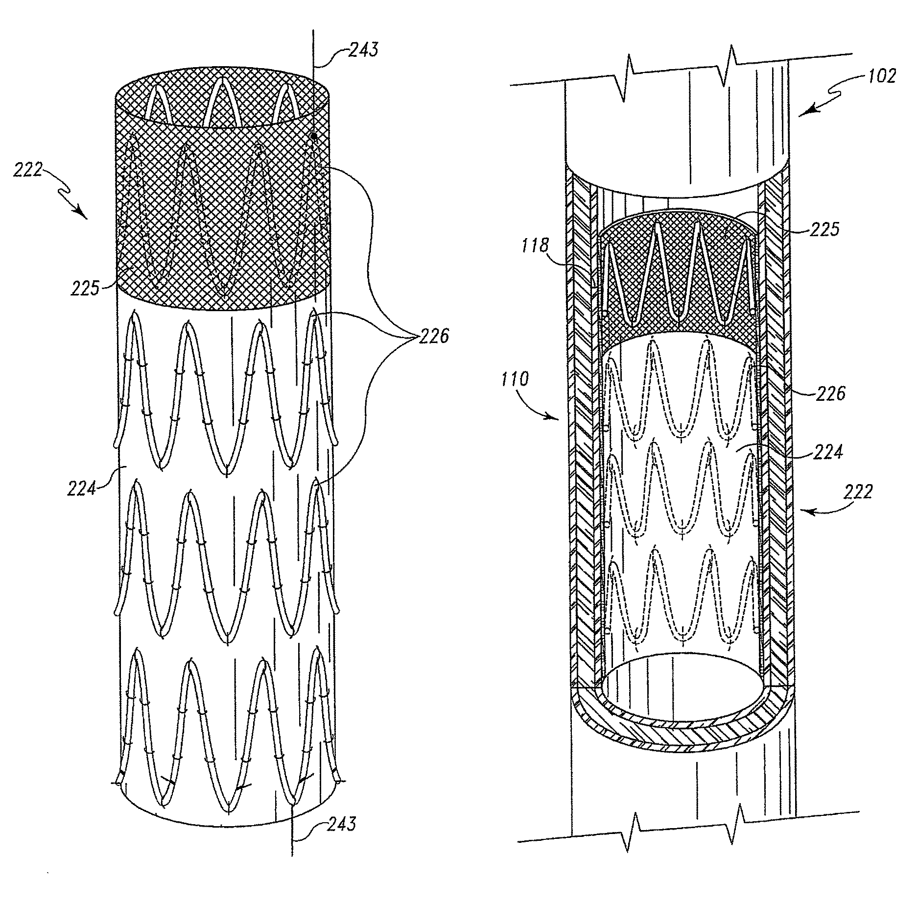 Multi-portion endoluminal prosthesis