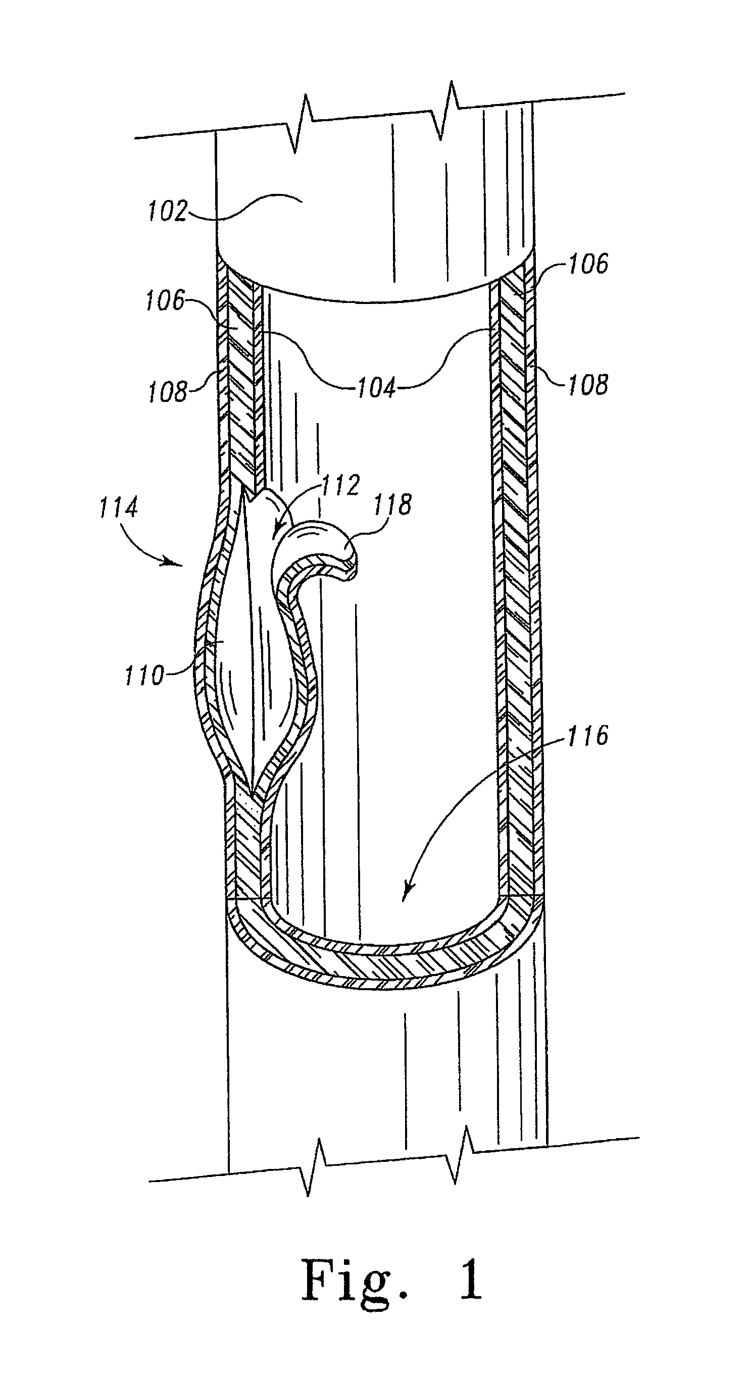 Multi-portion endoluminal prosthesis