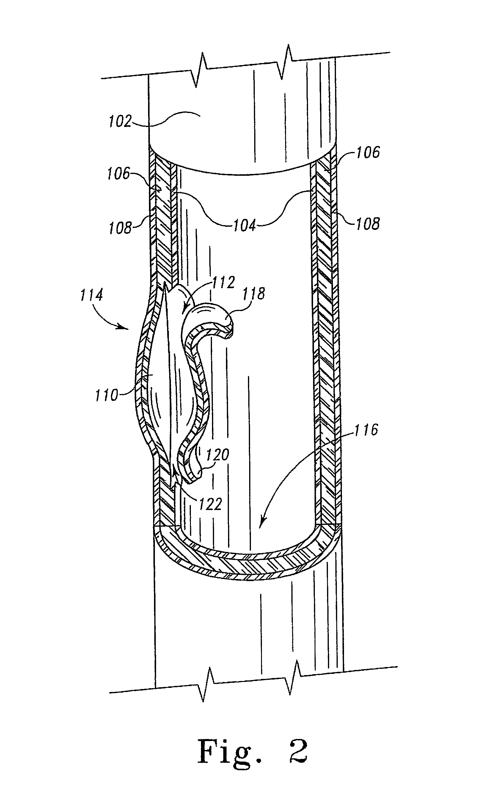 Multi-portion endoluminal prosthesis