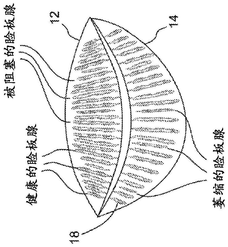 Systems and methods for the treatment of eye conditions