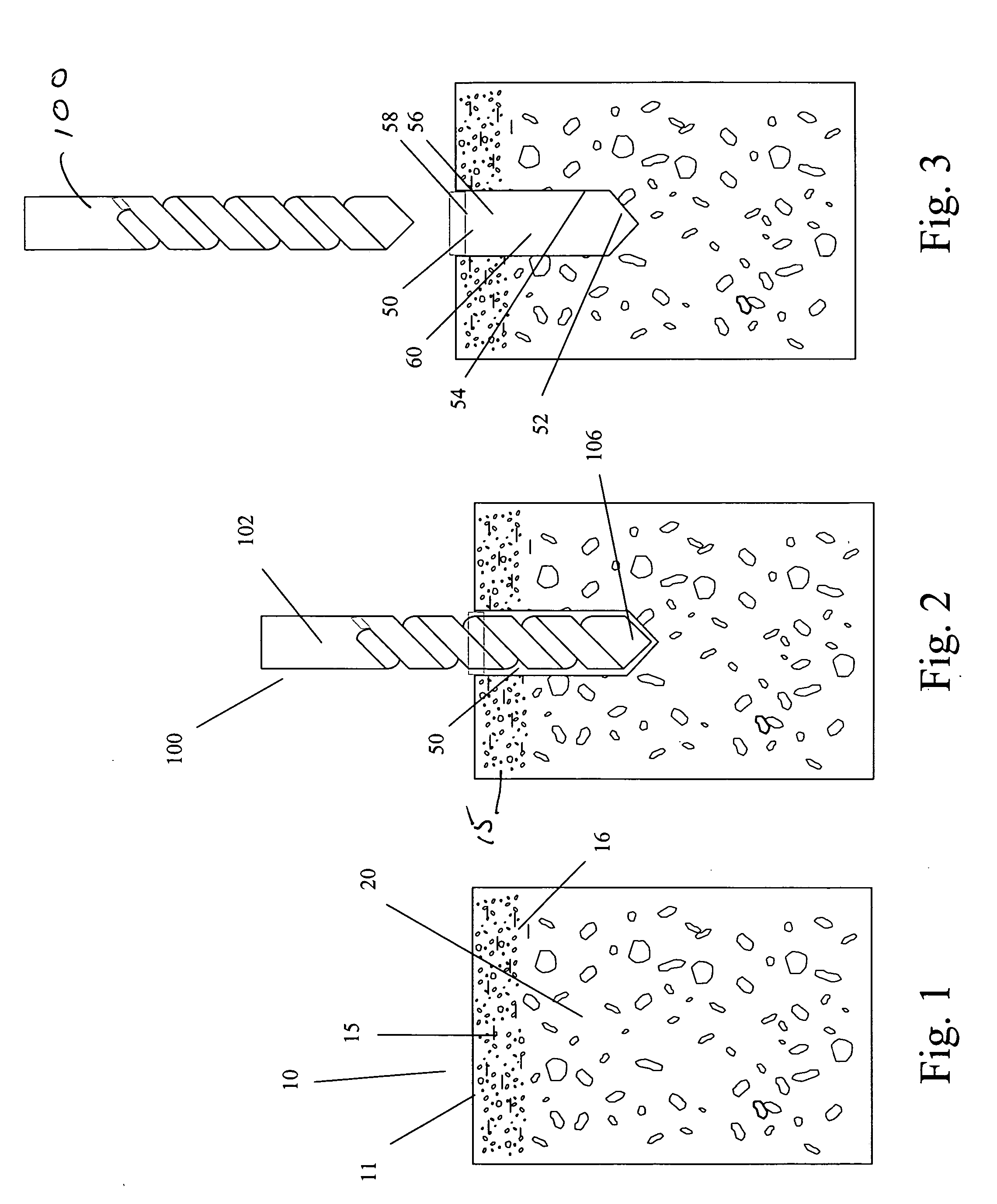 Suture anchor and void filler combination