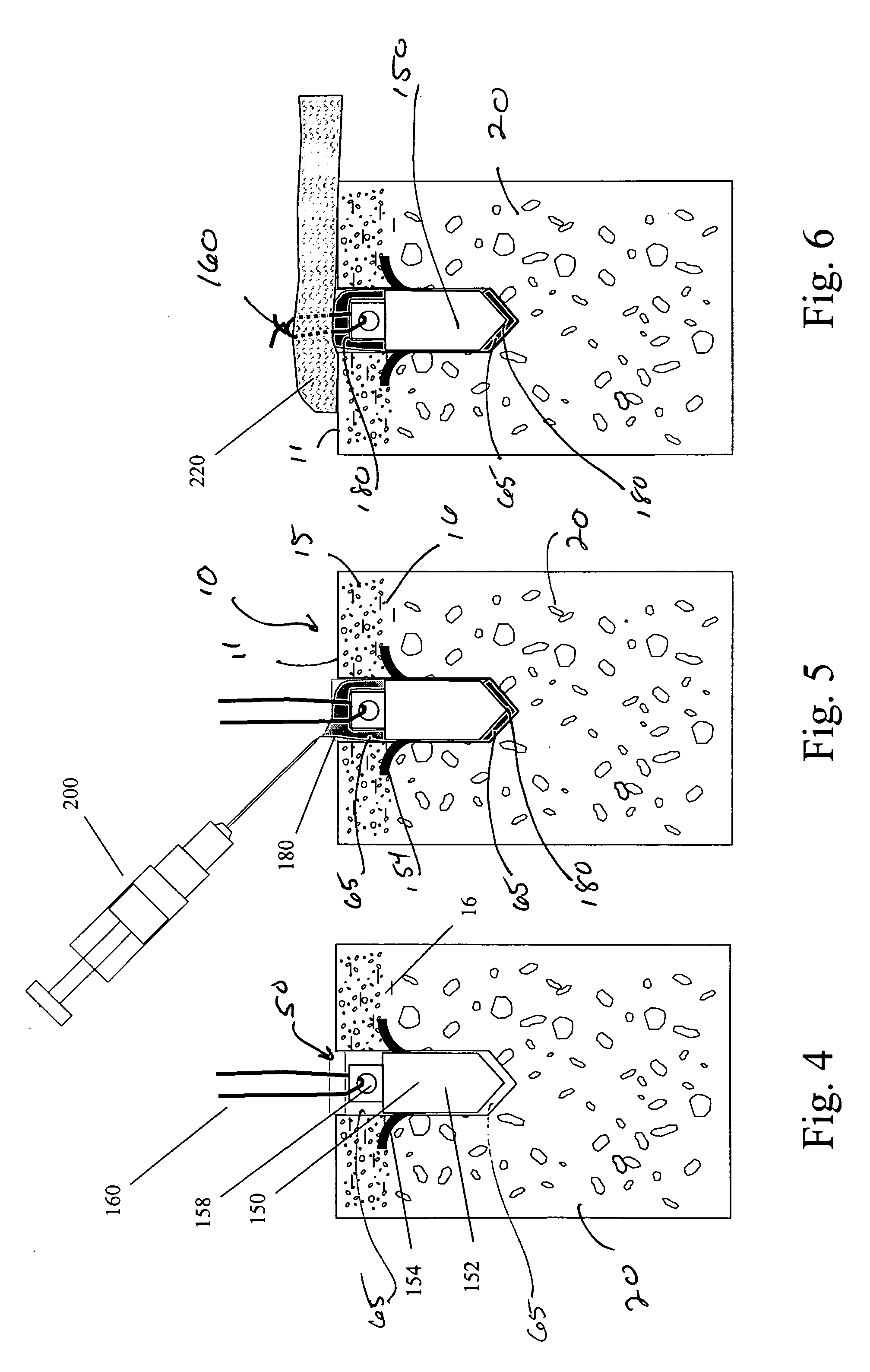 Suture anchor and void filler combination