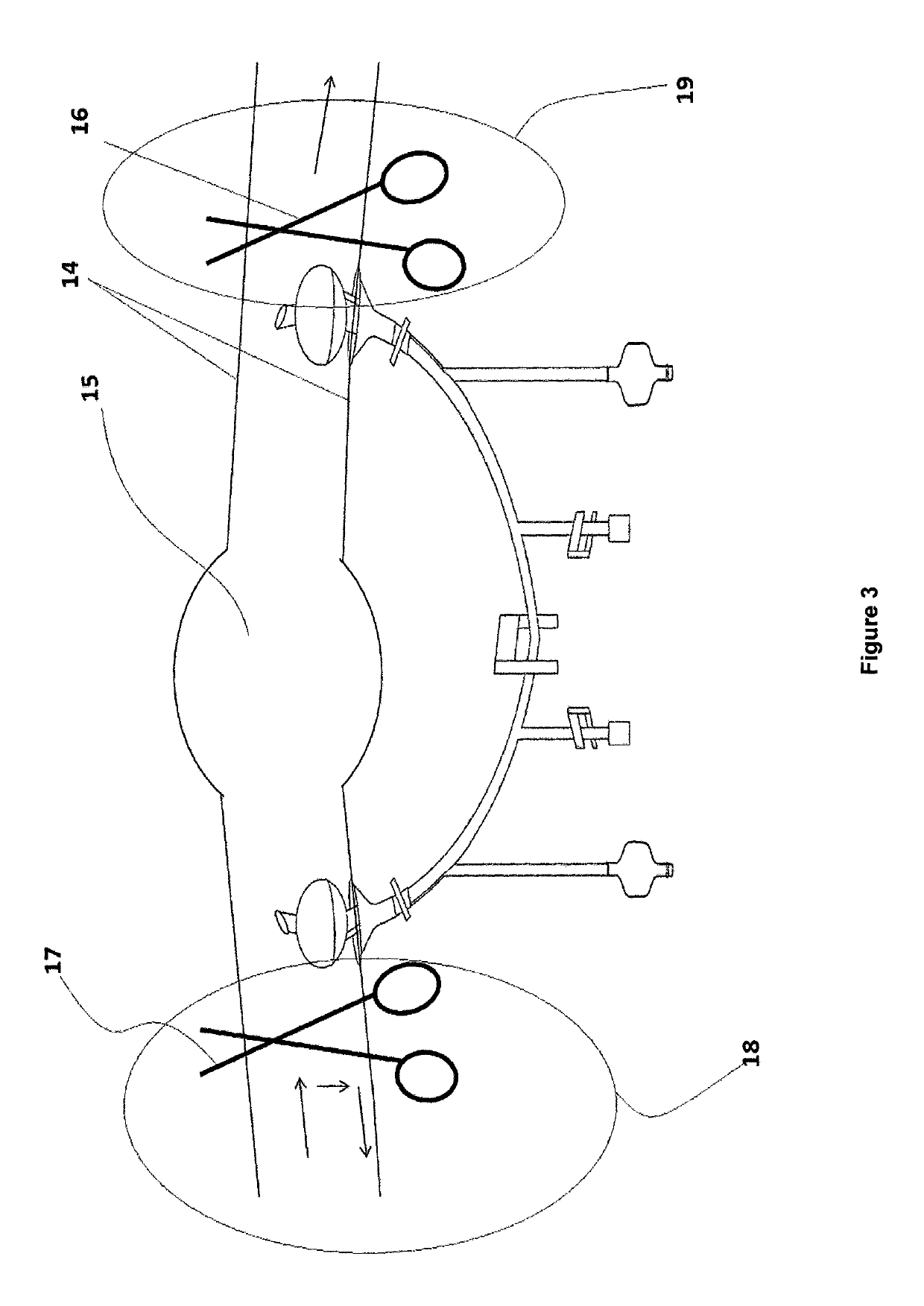 Catheter maintaining blood flow by vein bypass