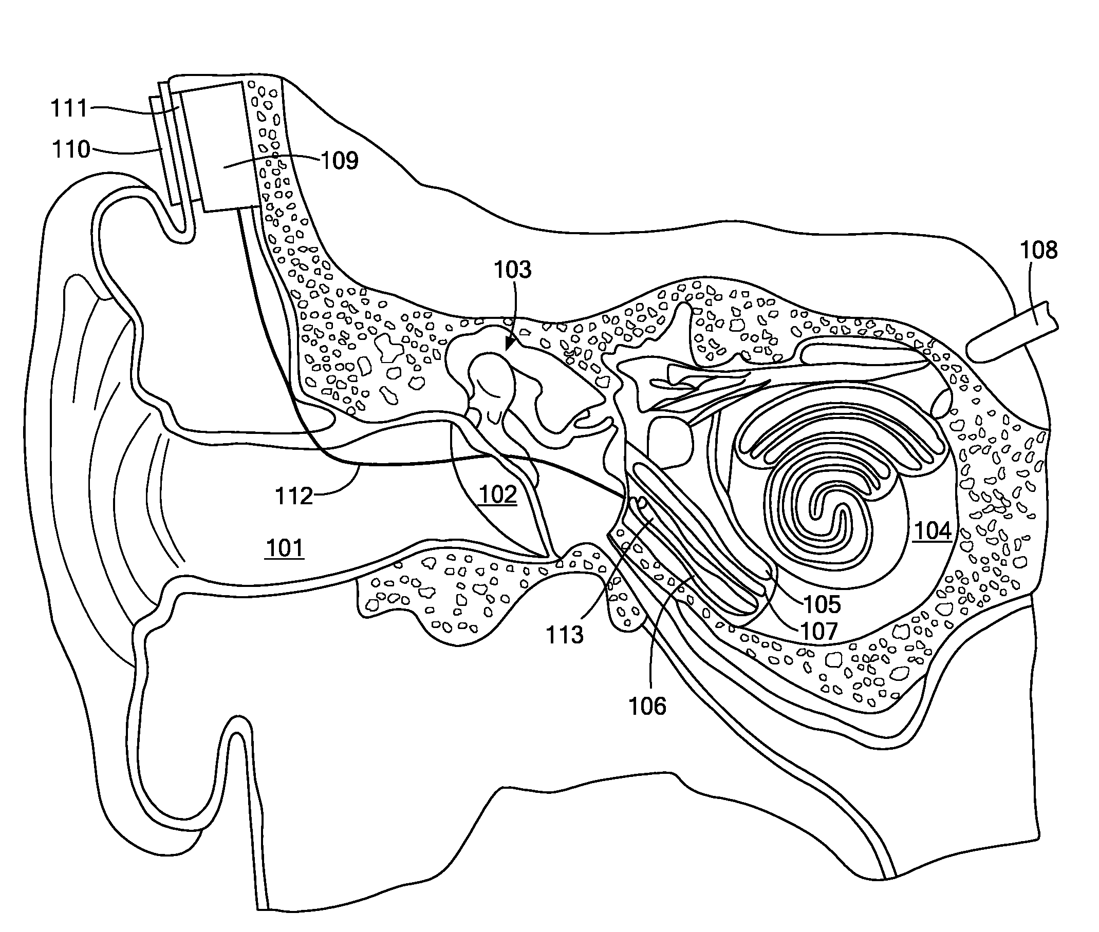 Cochlear Implant Pitch Intensity