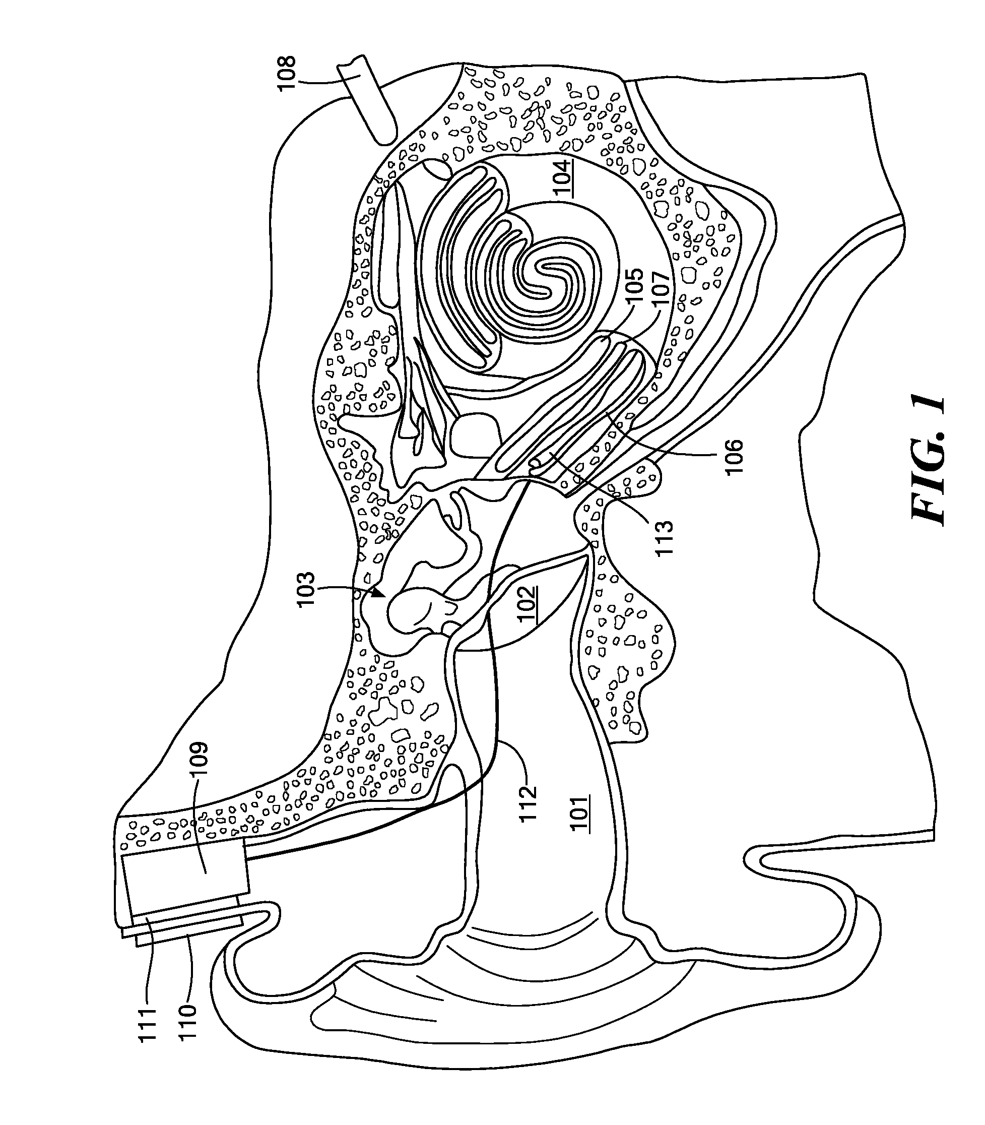 Cochlear Implant Pitch Intensity