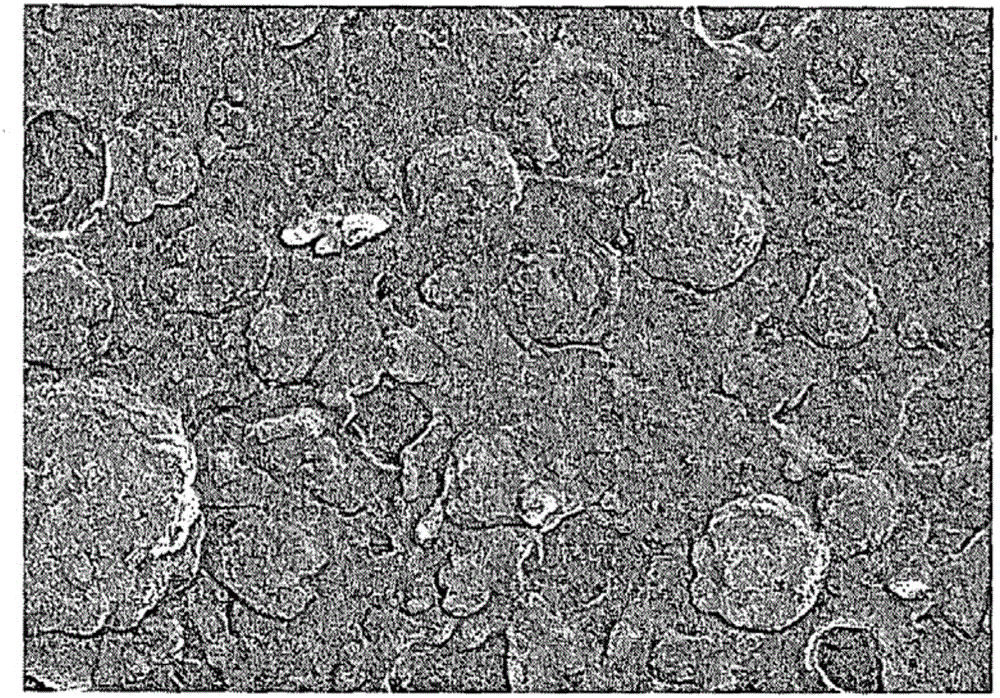 Liposome composition for treating acne, containing conjugate of lysophosphatidylcholine and chlorin e6