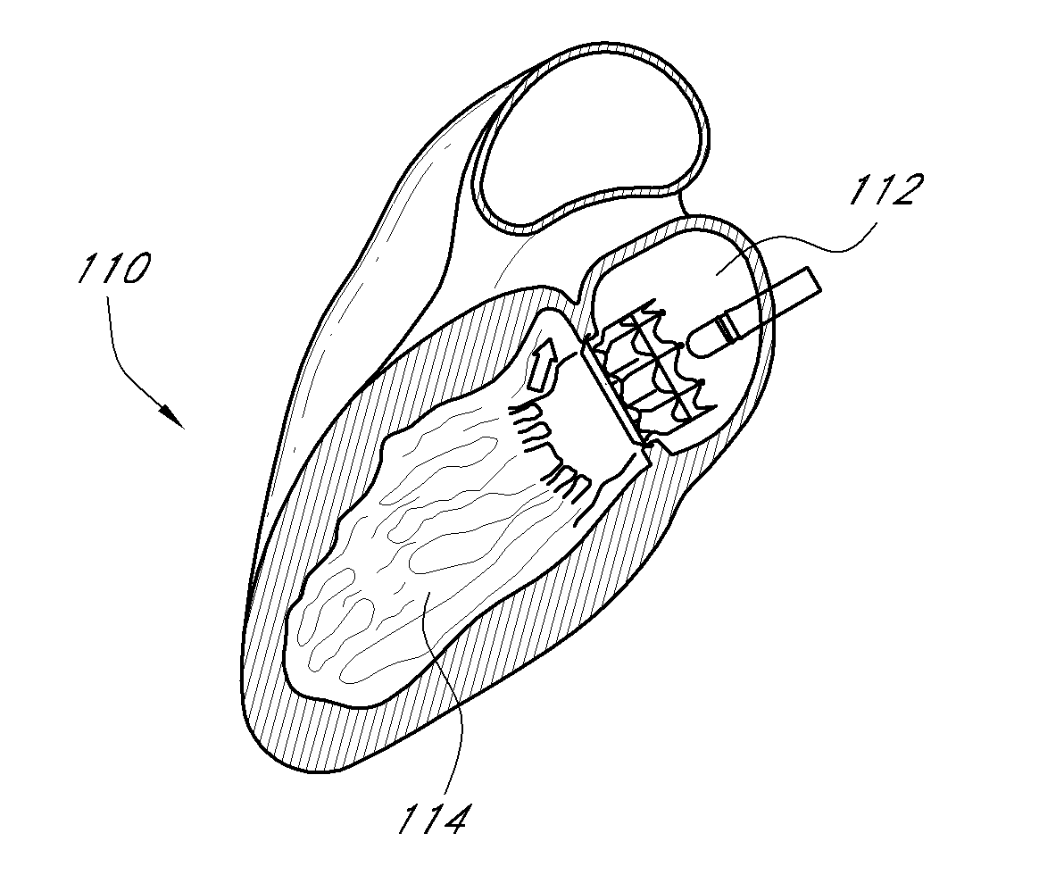 Vascular implant and delivery system