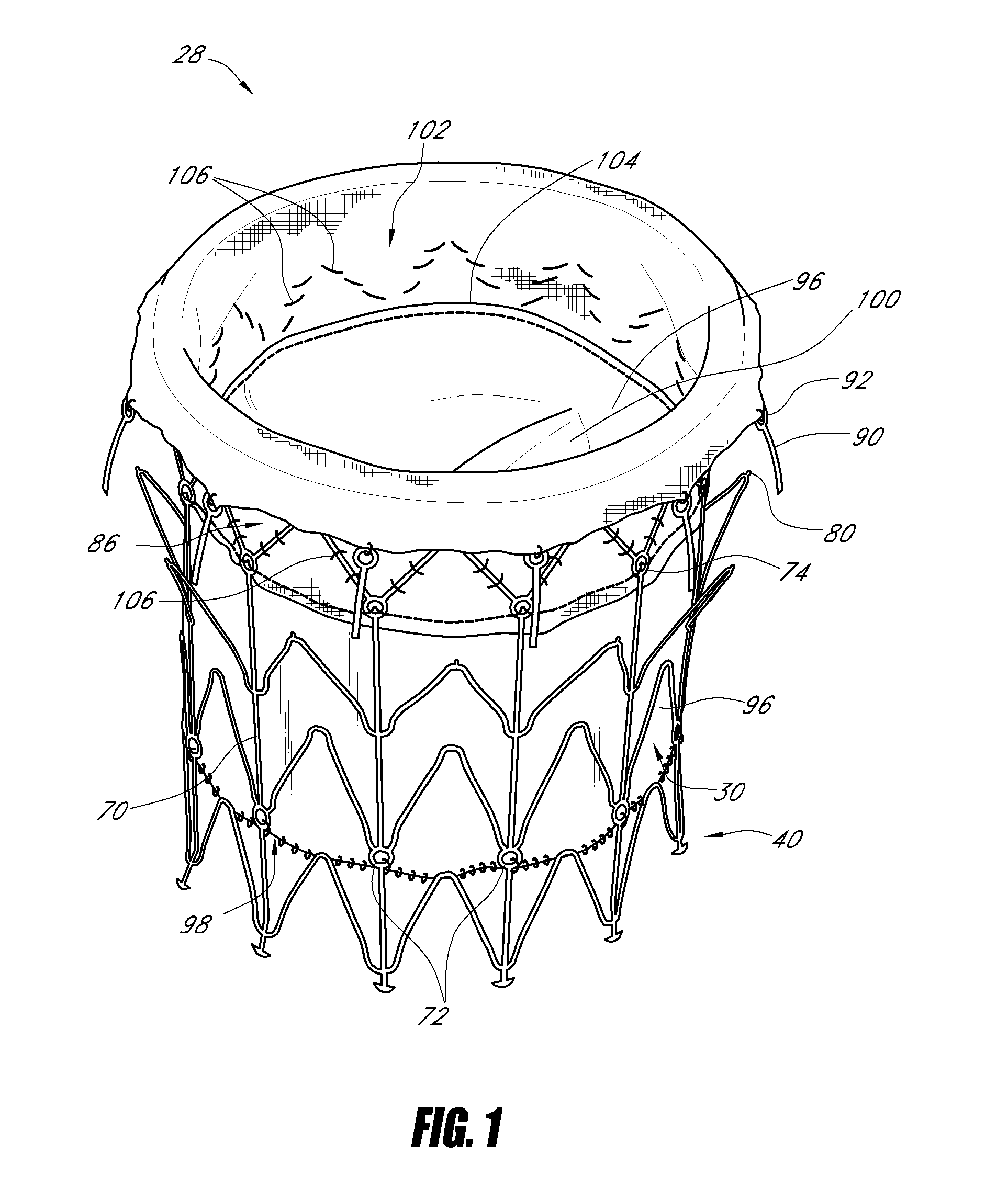 Vascular implant and delivery system