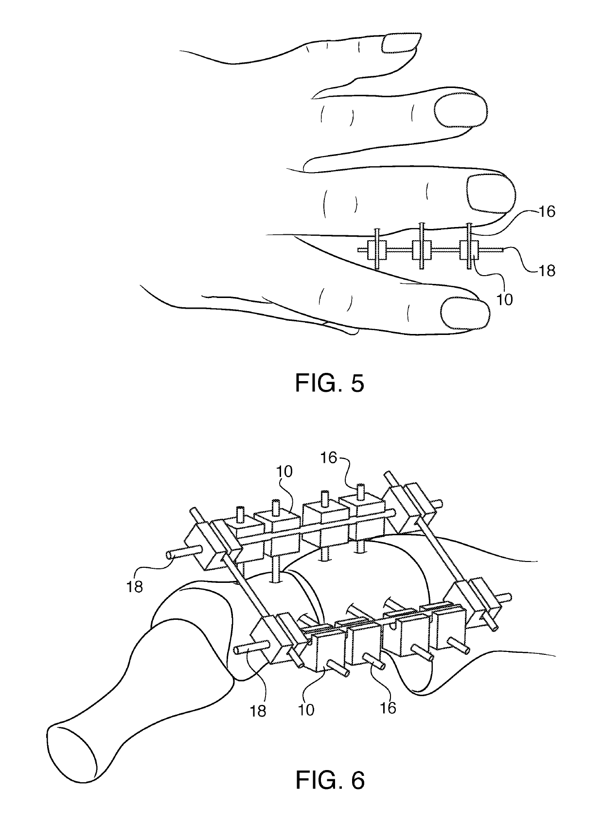 Bracket for external fixation of bones