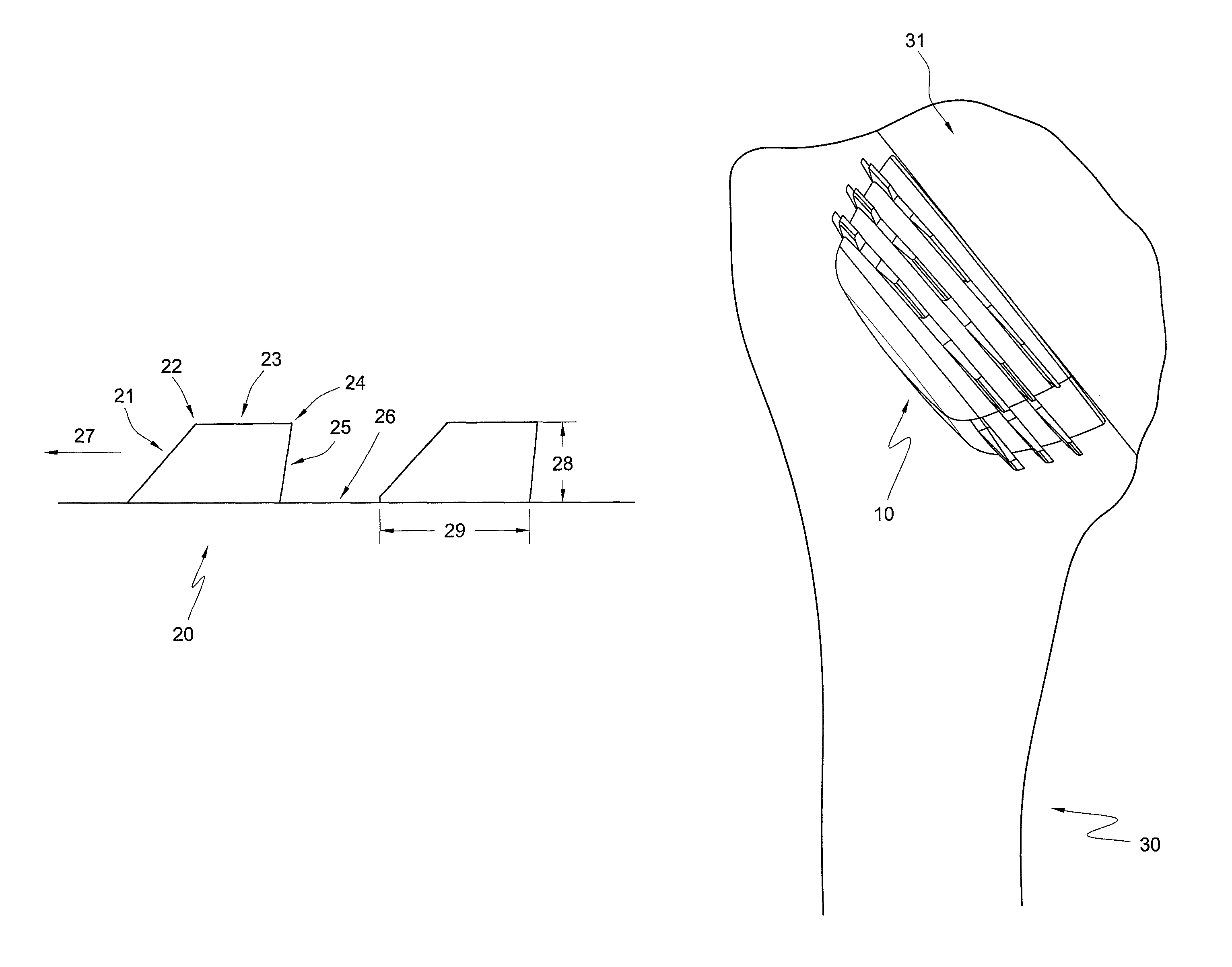 Stemless shoulder implant