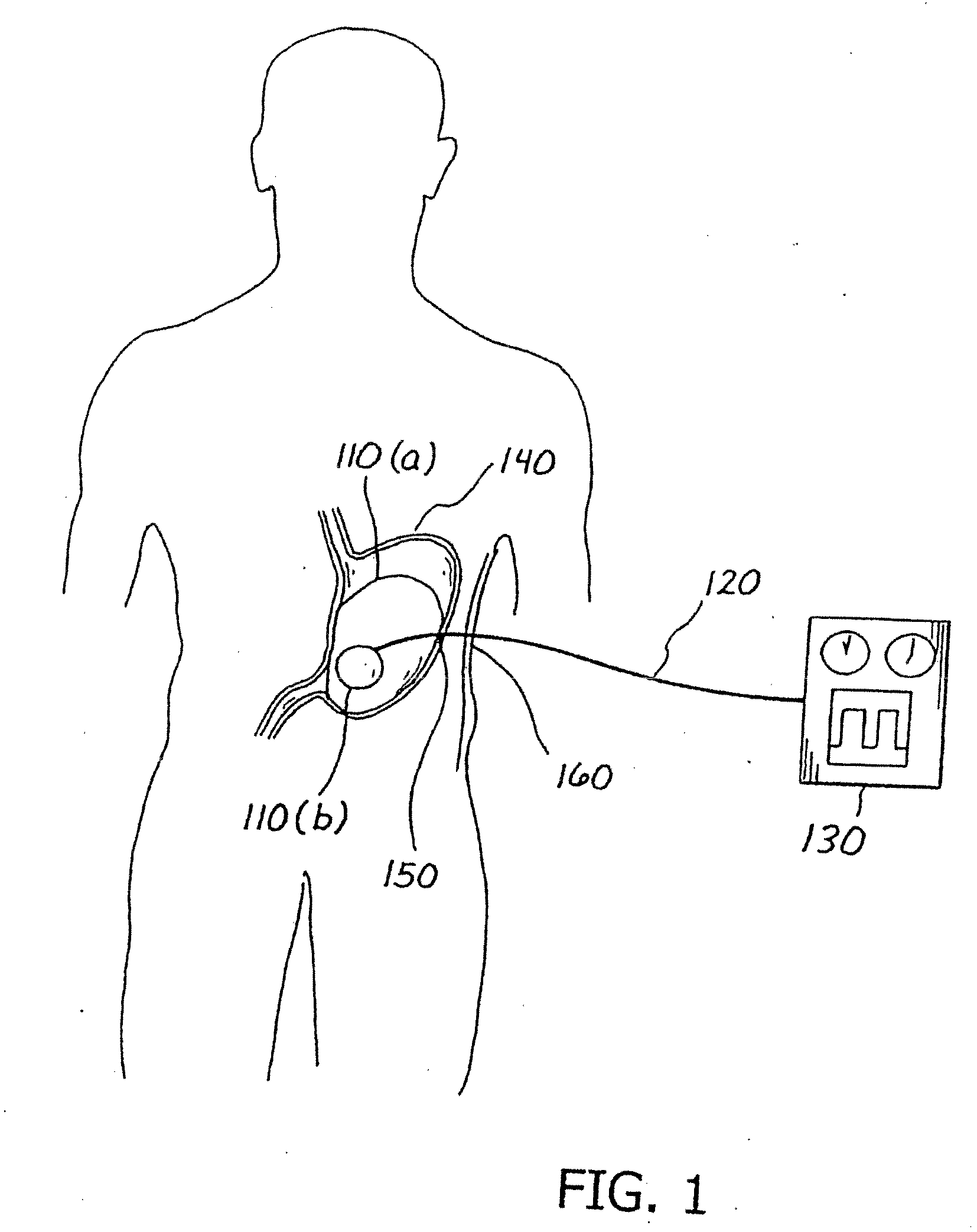 Balloon System and Methods for Treating Obesity