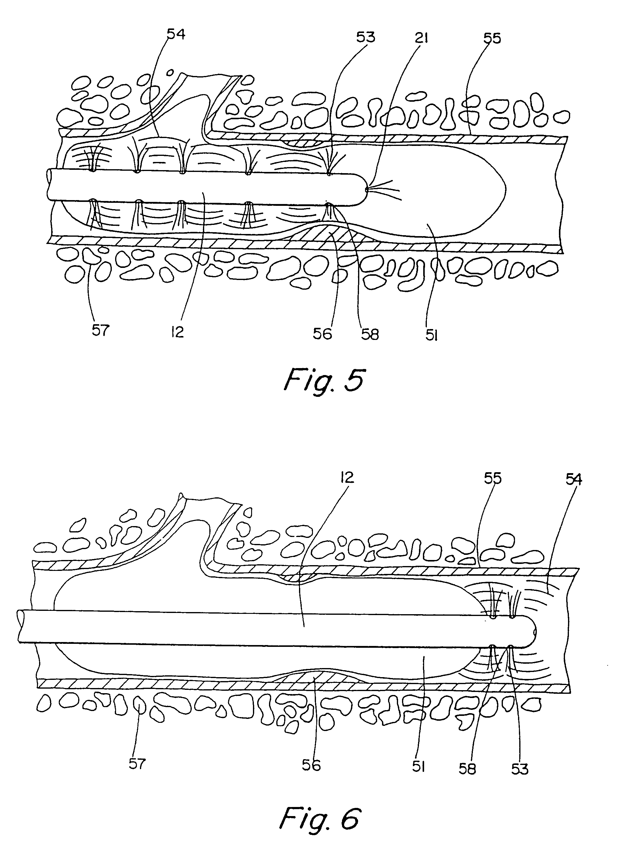 Thrombolysis device