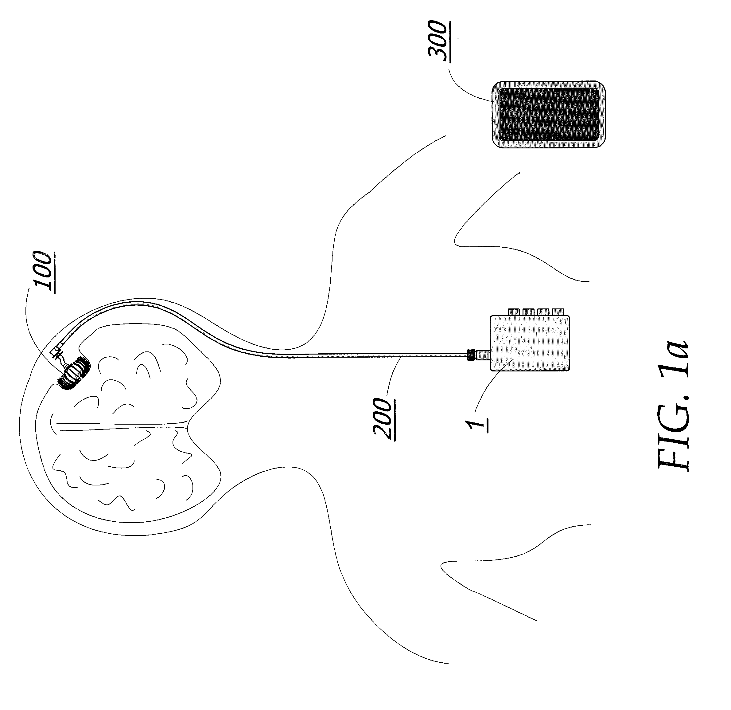 Metronomic Convection Enhanced Delivery of Intrathecal Chemotherapy Using an Implanted Magnetic Breather Pump (MBP) for Leptomeningeal Carcinomatosis