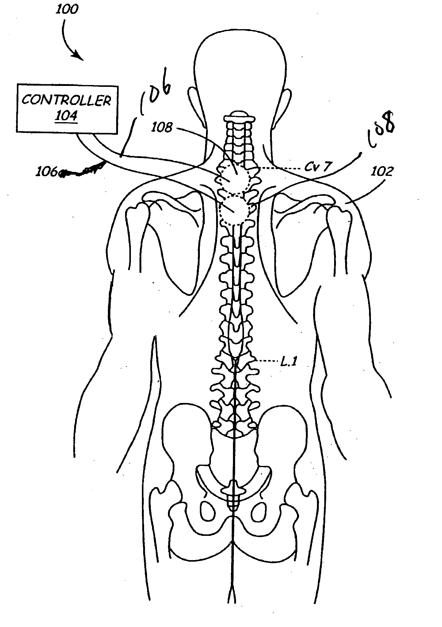 Methods and apparatus for sensing cardiac activity via neurological stimulation therapy system or medical electrical lead