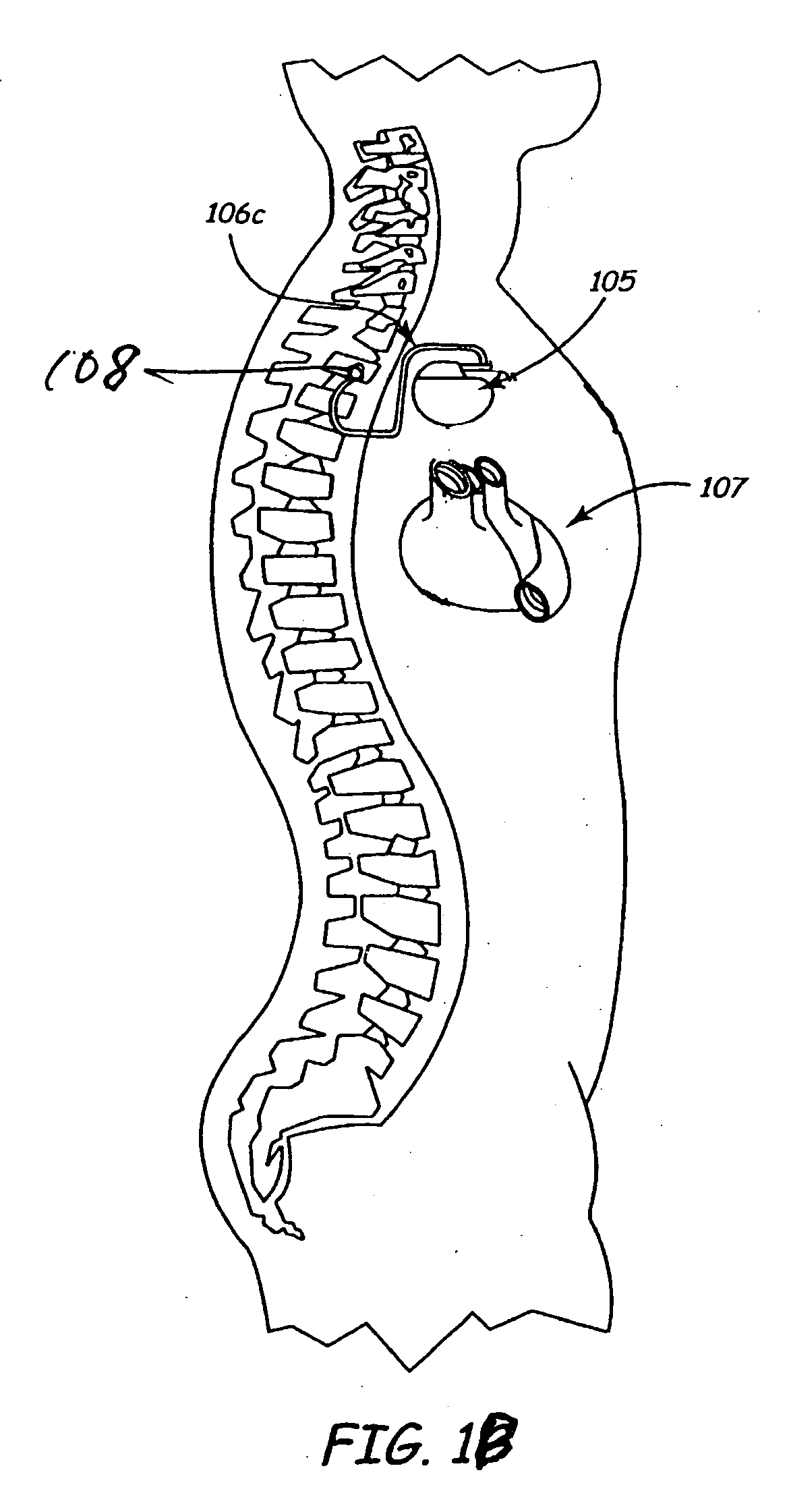 Methods and apparatus for sensing cardiac activity via neurological stimulation therapy system or medical electrical lead