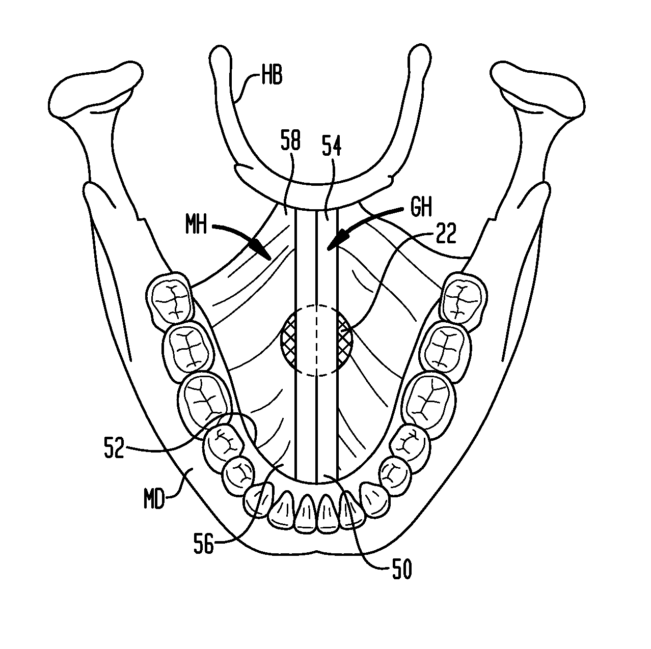 Implant systems and methods for treating obstructive sleep apnea