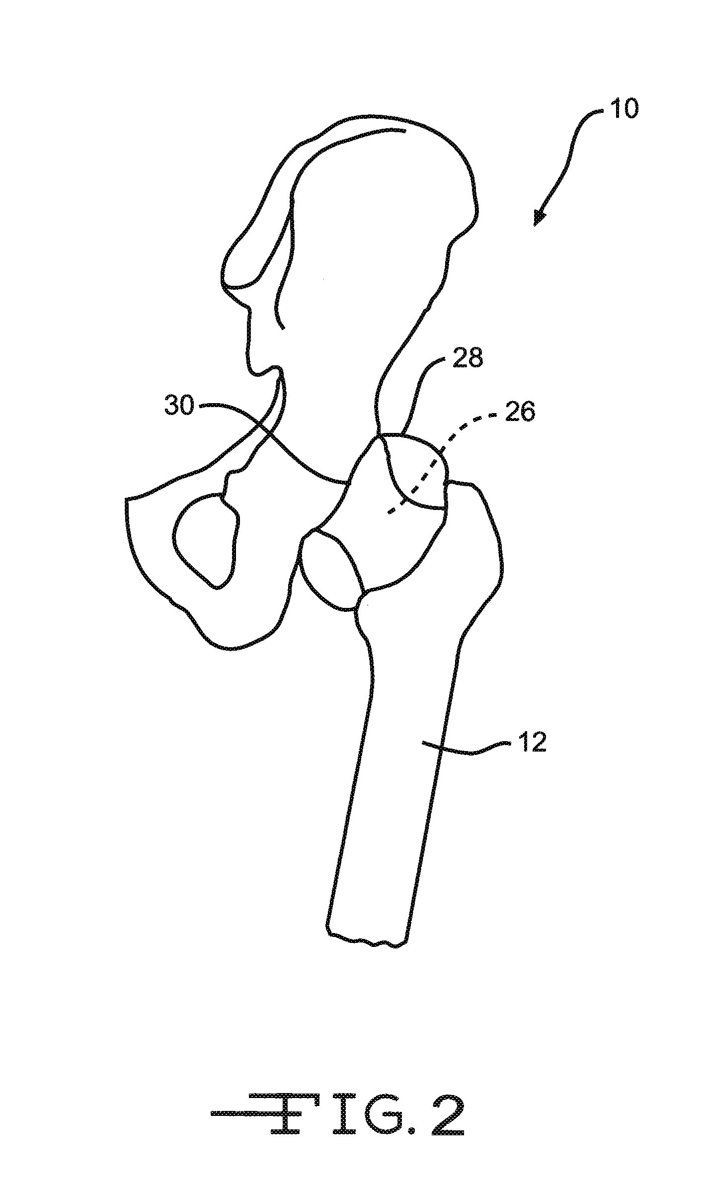 Retractor Tool For Minimally Invasive Hip Replacement Surgery