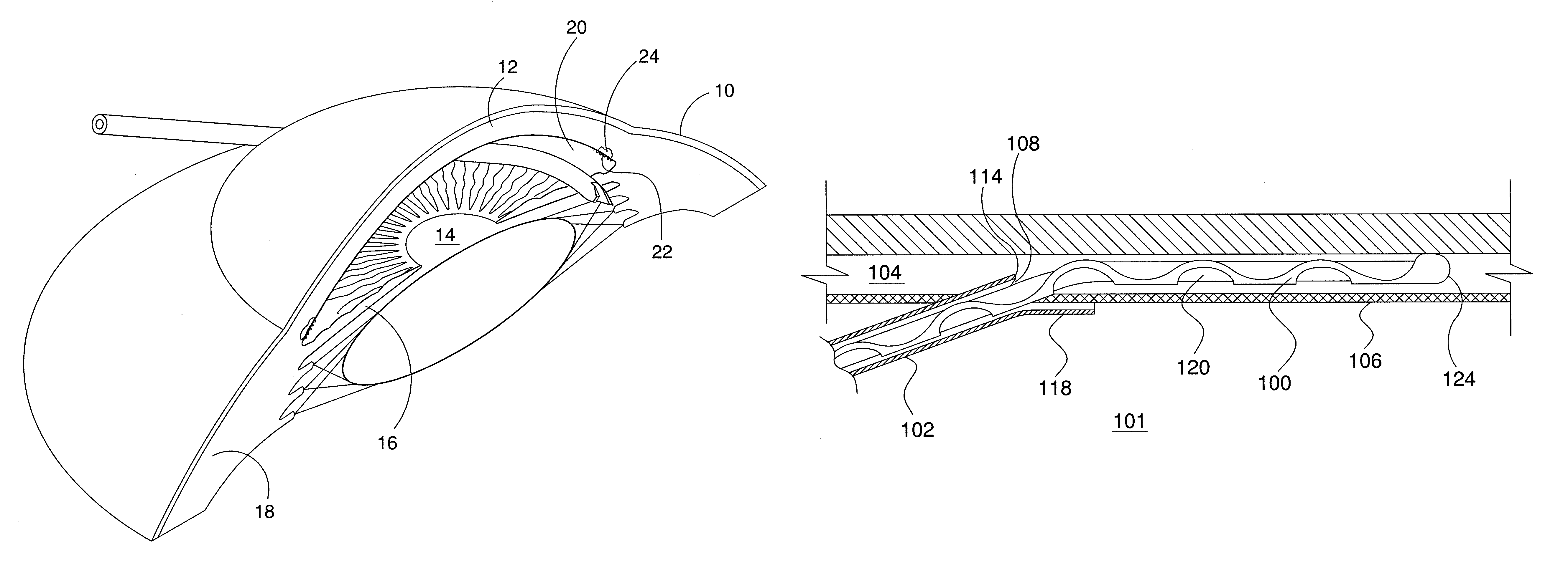 Ocular implant delivery system and method