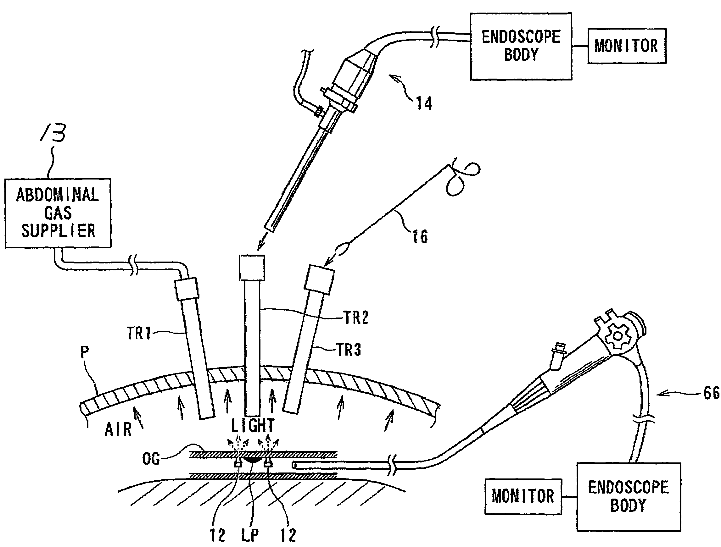 Method of identifying a lesion inside patient'S tubular organ