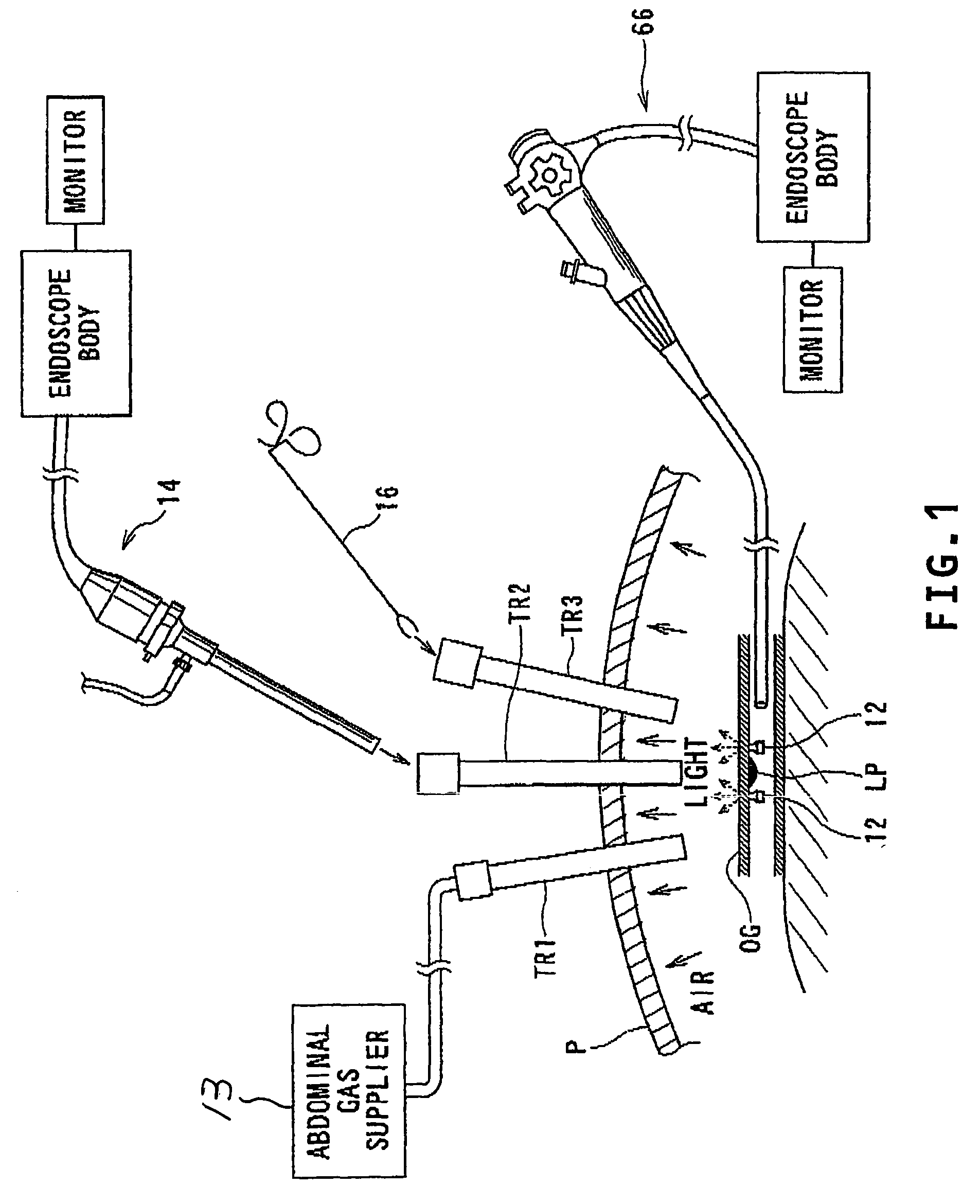 Method of identifying a lesion inside patient'S tubular organ