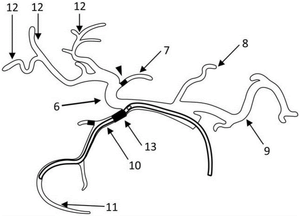 A hepatic artery drug box indwelling catheter system