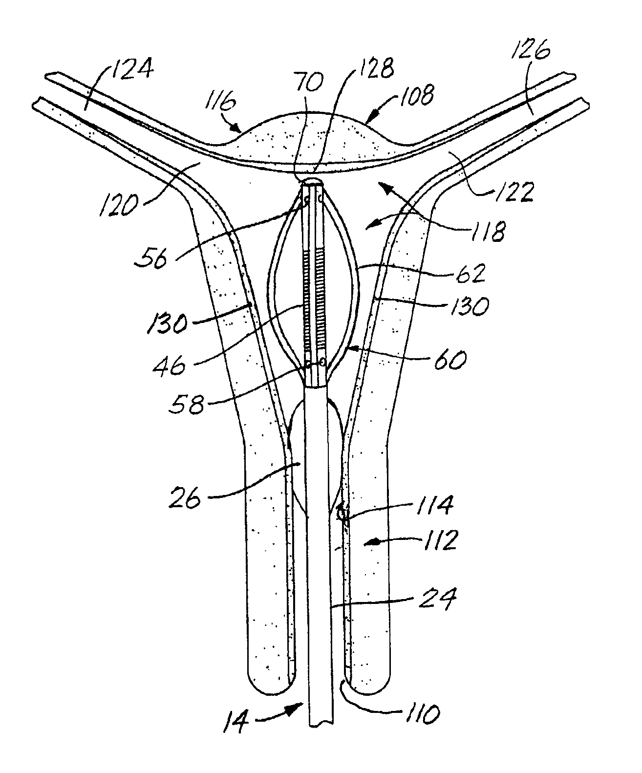 Thermal ablation with deployable cage