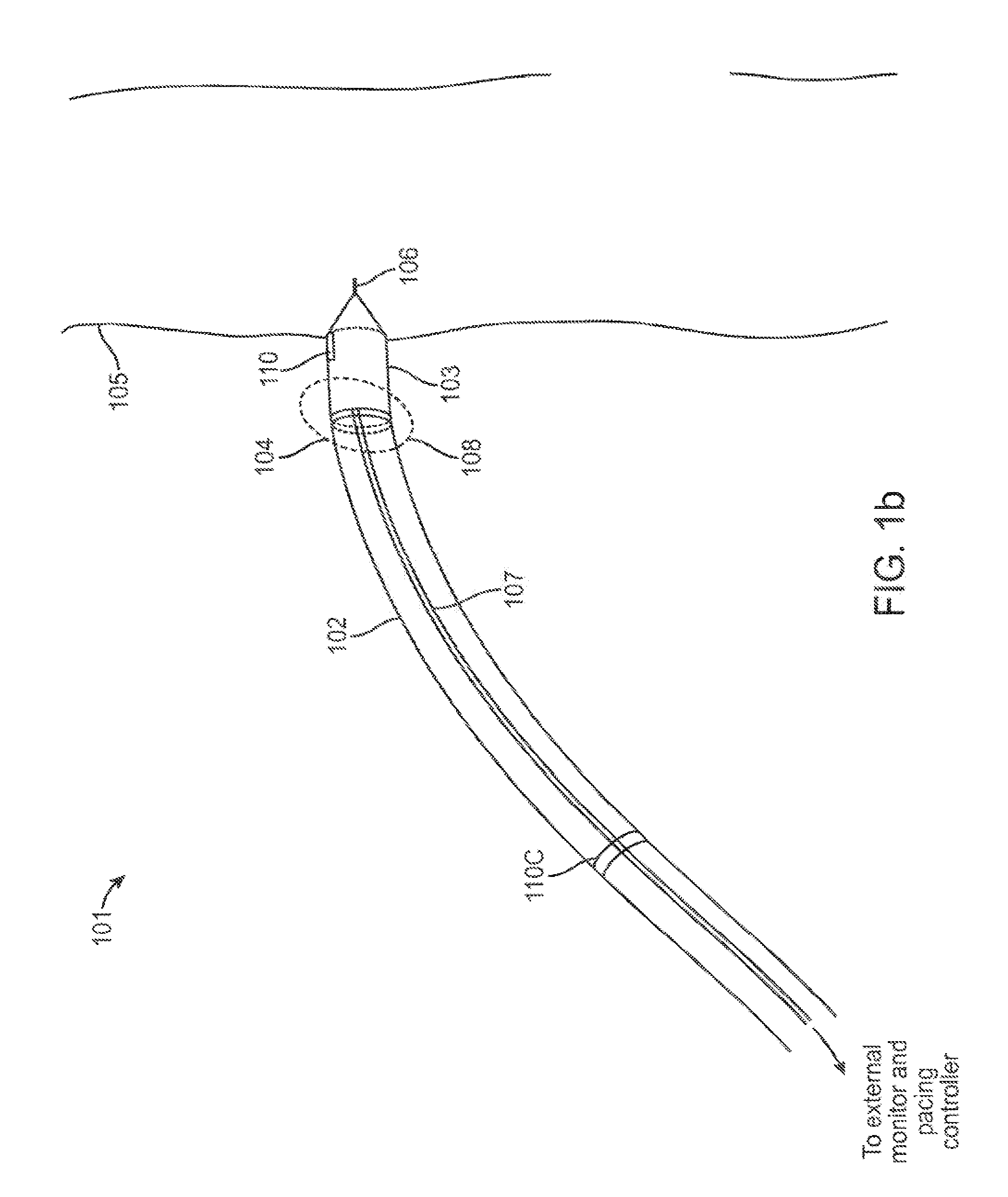 Temporary electrode connection for wireless pacing systems